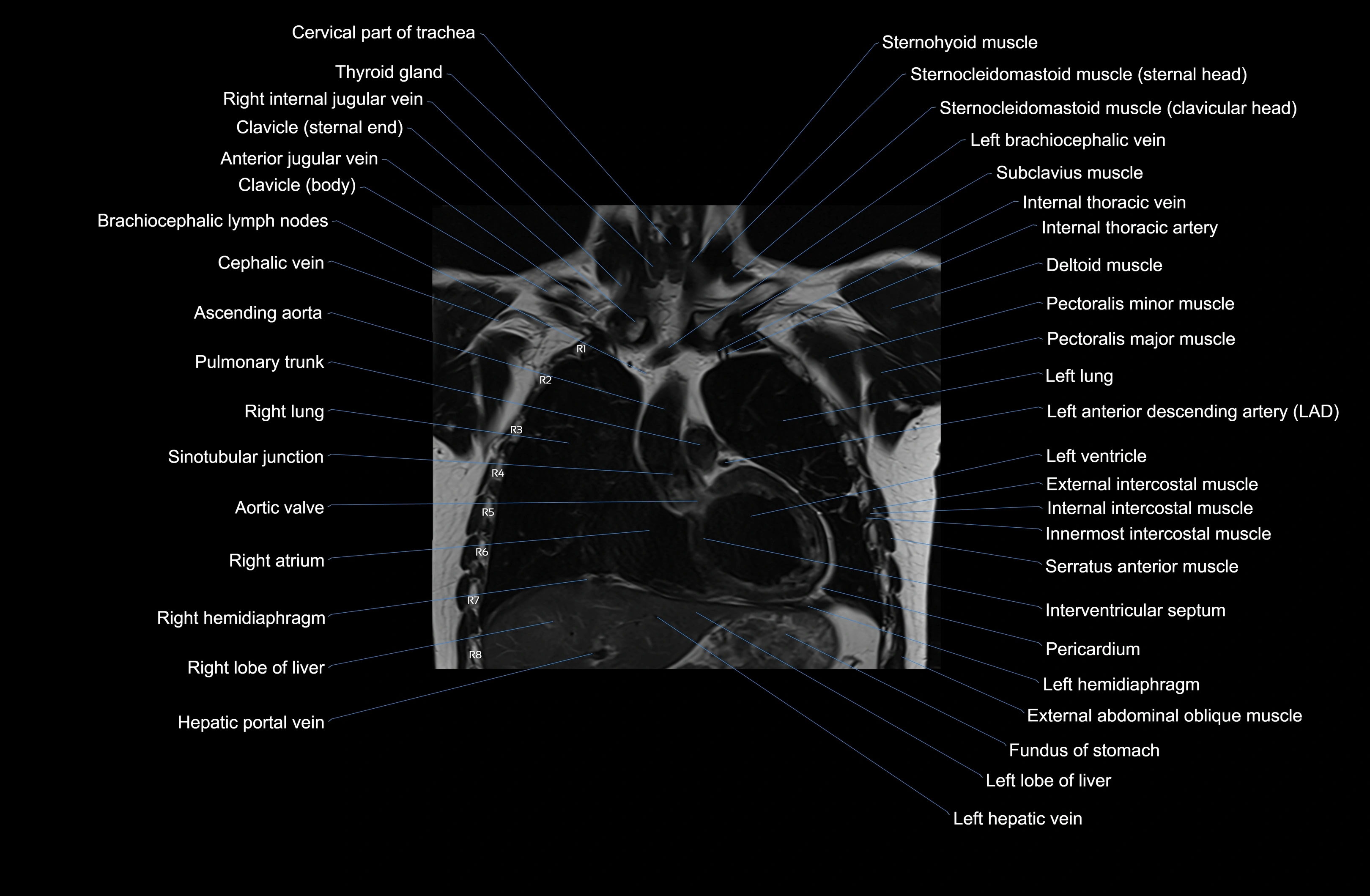MRI Chest Anatomy – Axial, Coronal & Sagittal Planes with Labeled Images