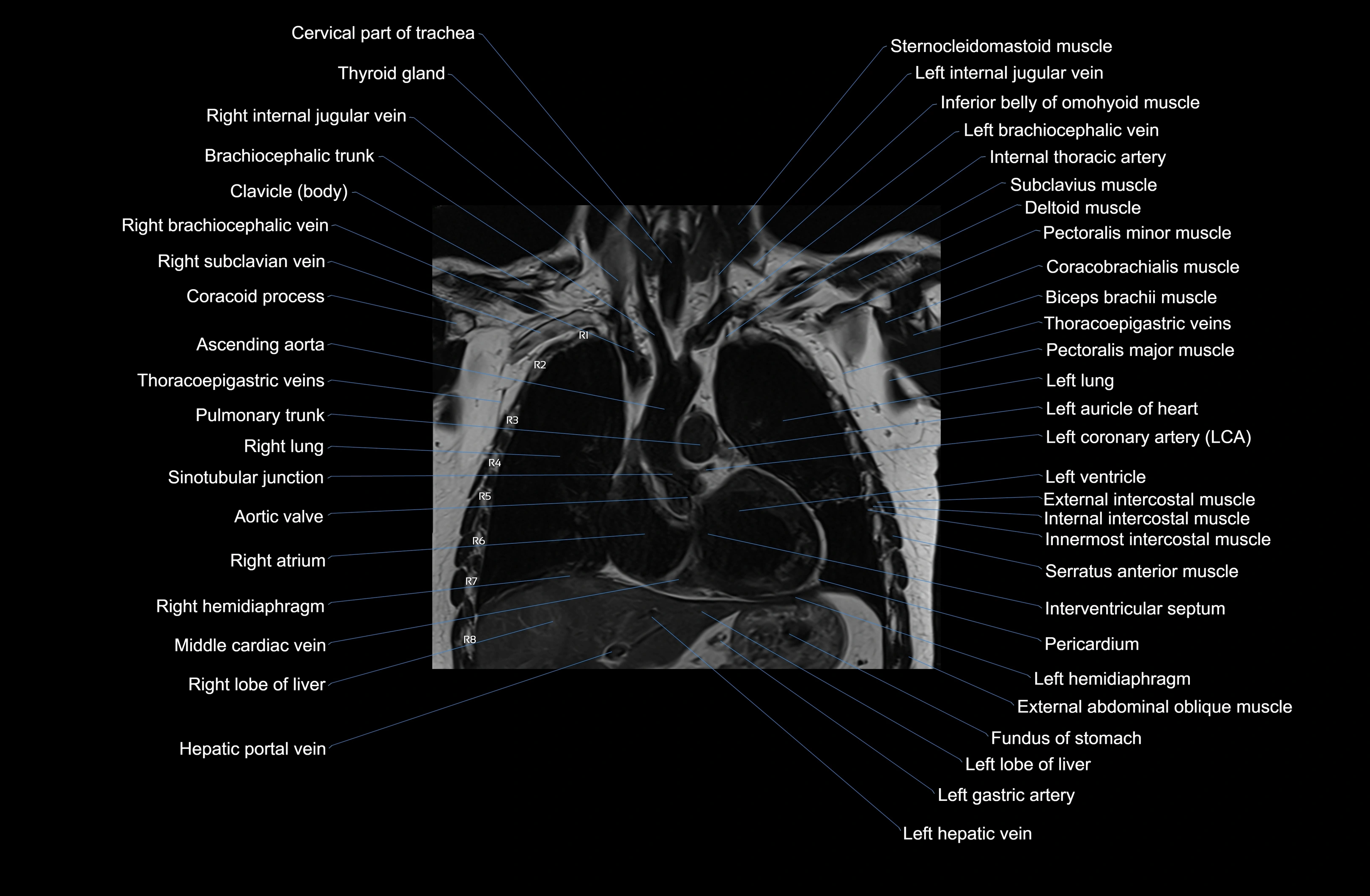 MRI Chest Anatomy – Axial, Coronal & Sagittal Planes with Labeled Images