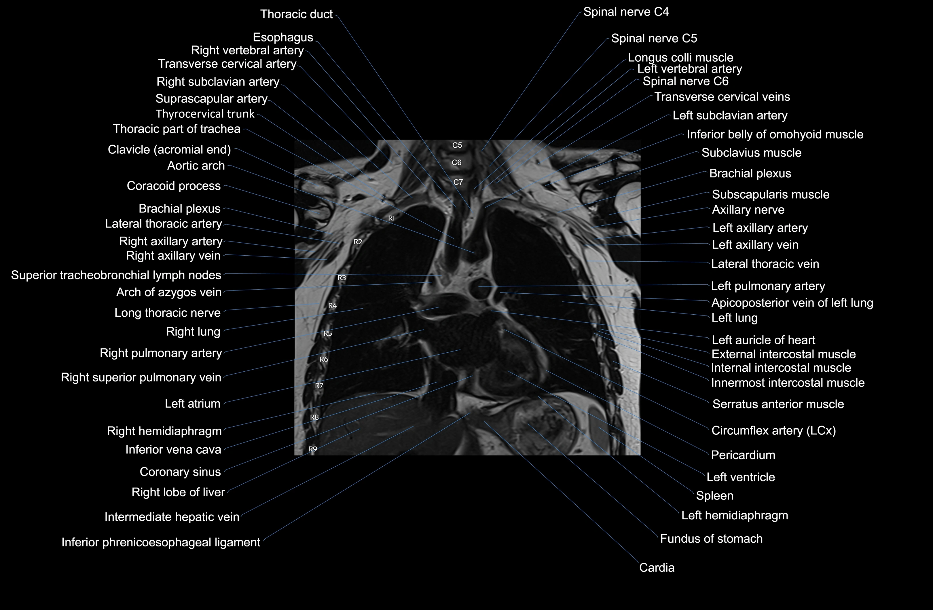MRI Chest Anatomy – Axial, Coronal & Sagittal Planes with Labeled Images