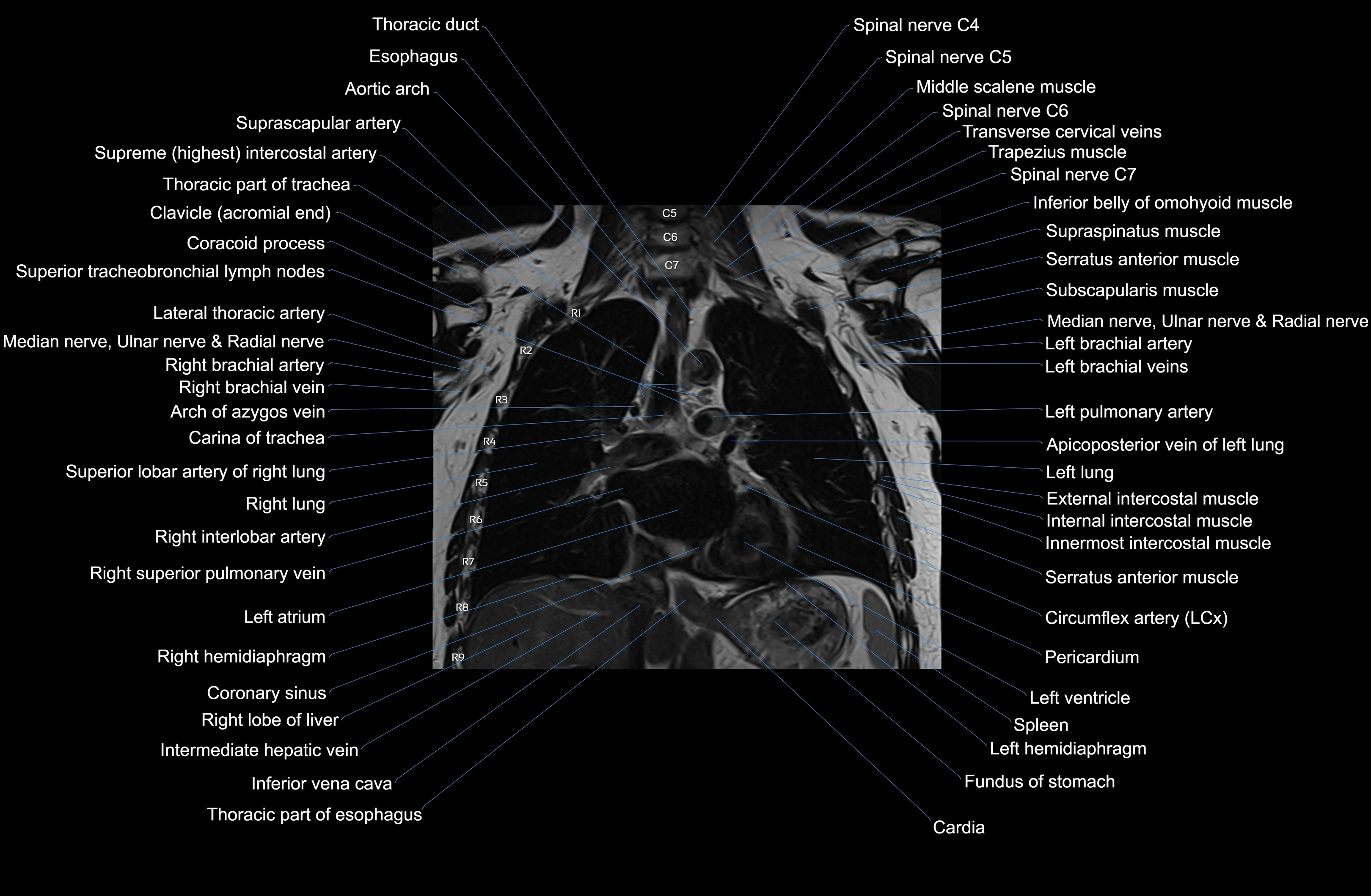 MRI Chest Anatomy – Axial, Coronal & Sagittal Planes with Labeled Images