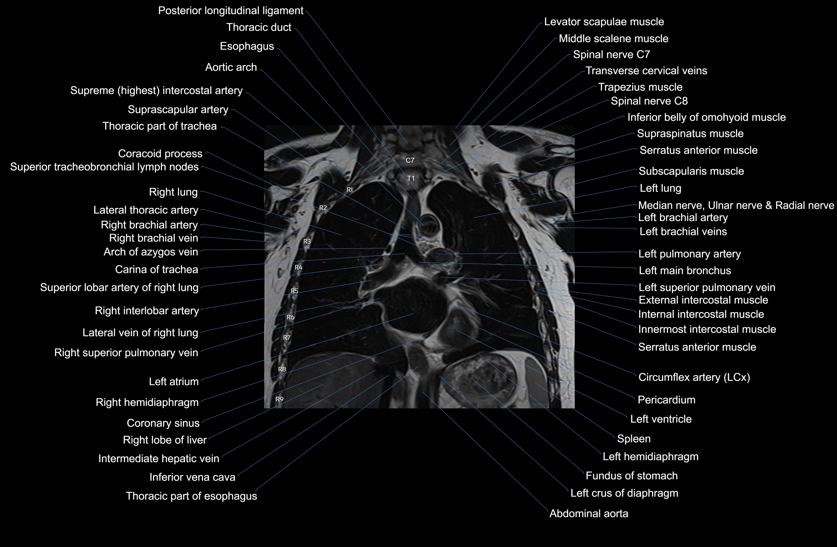 MRI Chest Anatomy – Axial, Coronal & Sagittal Planes with Labeled Images