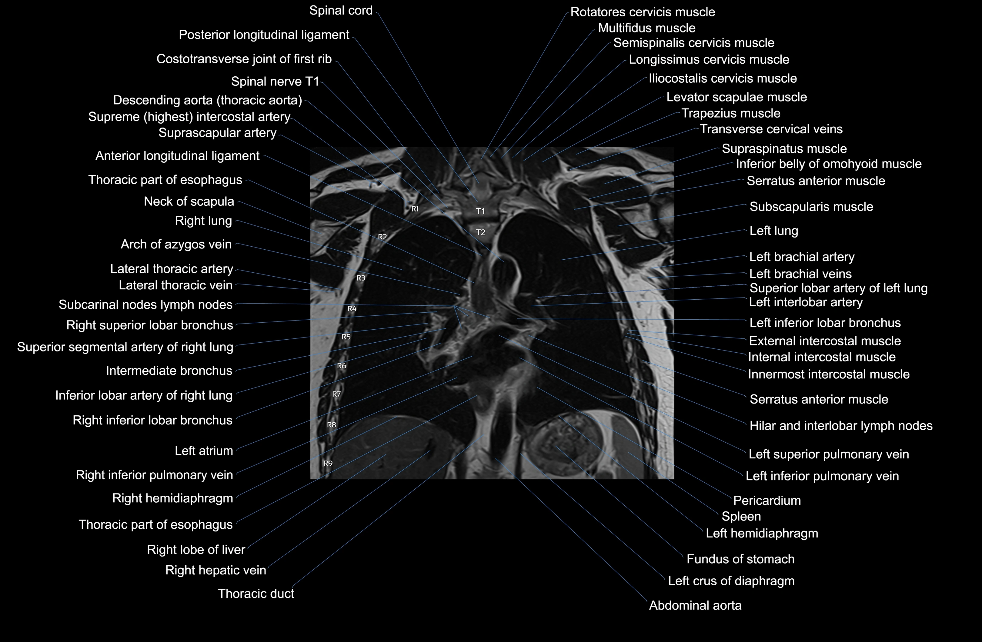MRI Chest Anatomy – Axial, Coronal & Sagittal Planes with Labeled Images