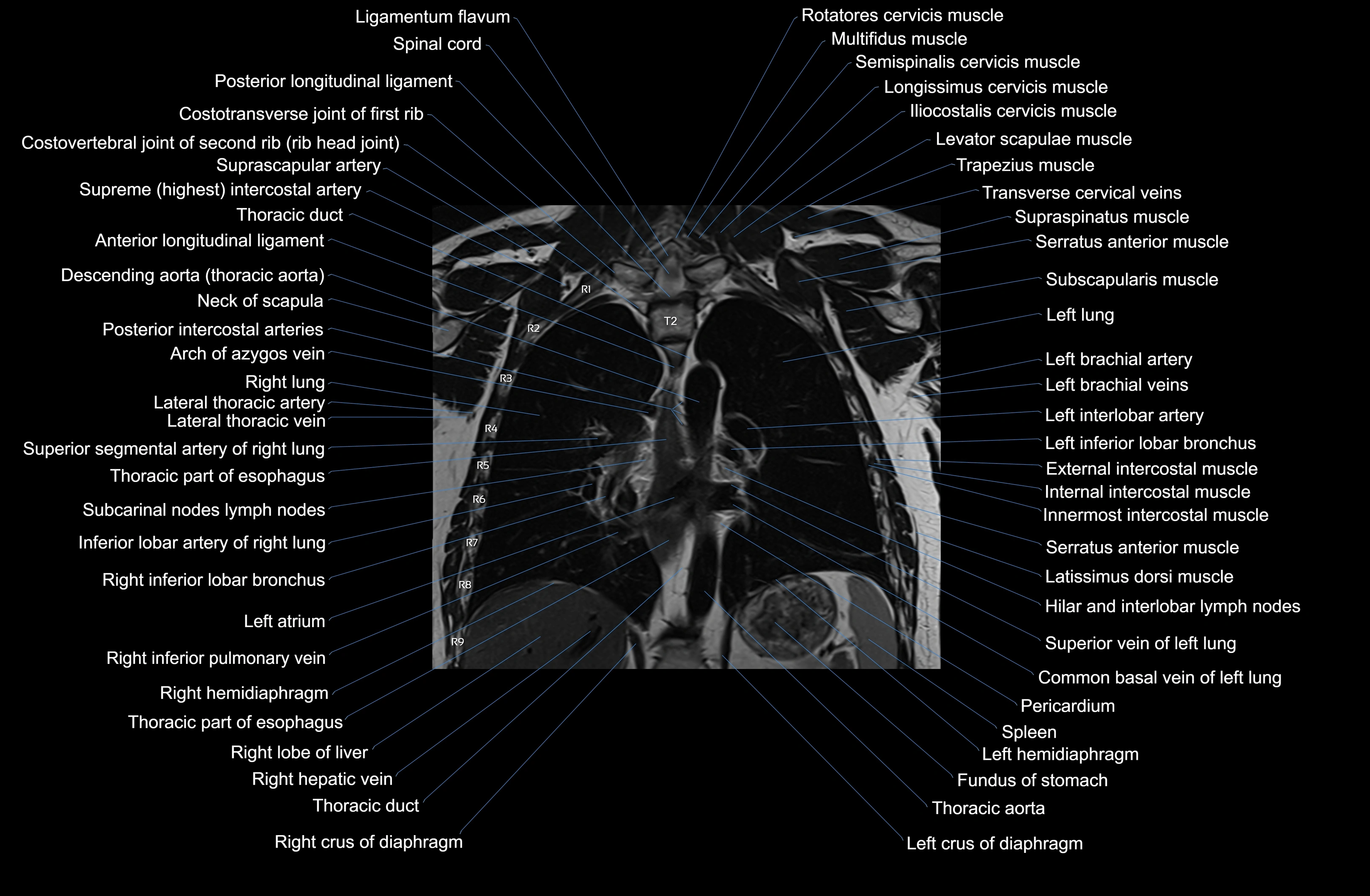 MRI Chest Anatomy – Axial, Coronal & Sagittal Planes with Labeled Images