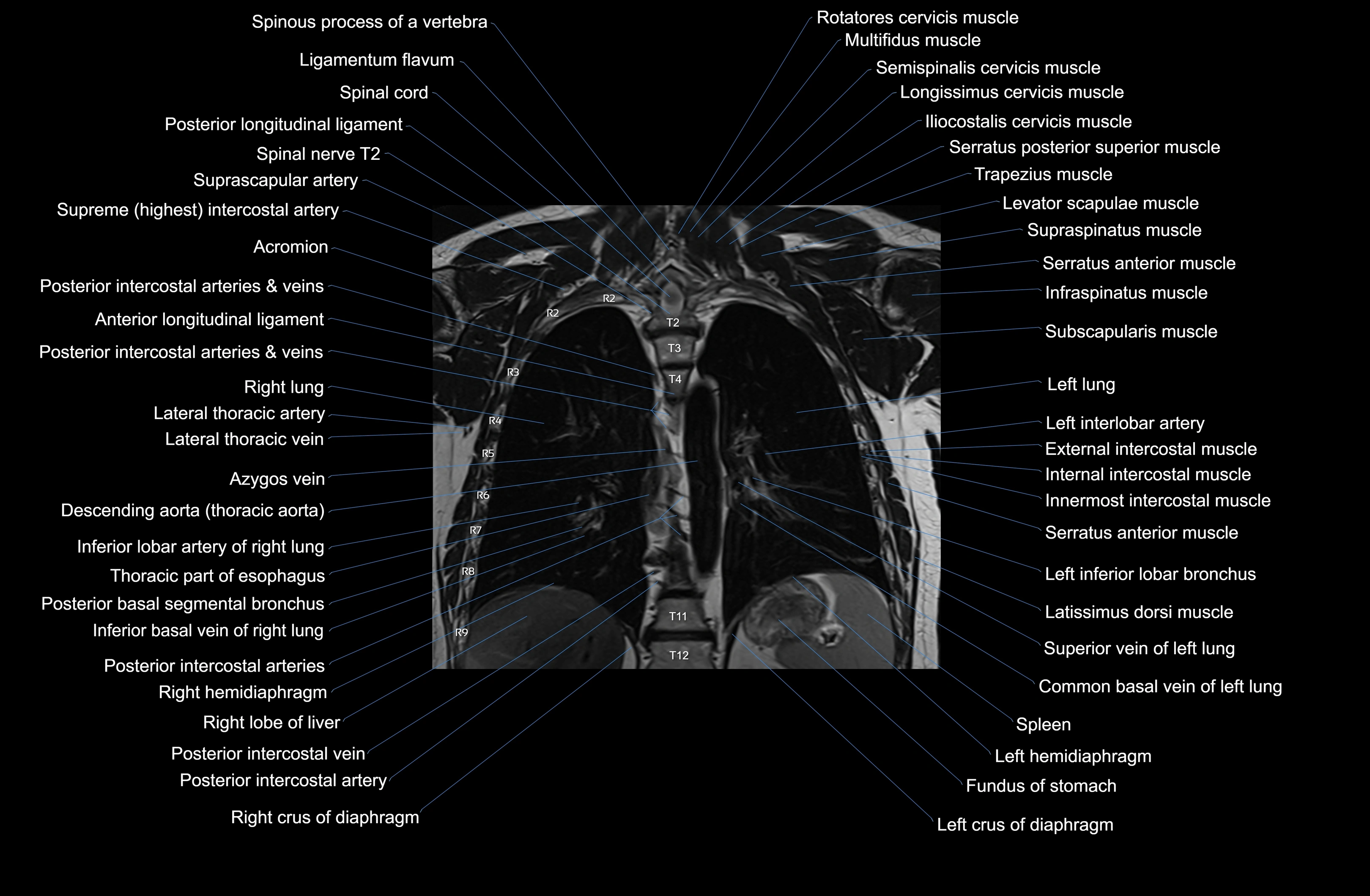 MRI Chest Anatomy – Axial, Coronal & Sagittal Planes with Labeled Images