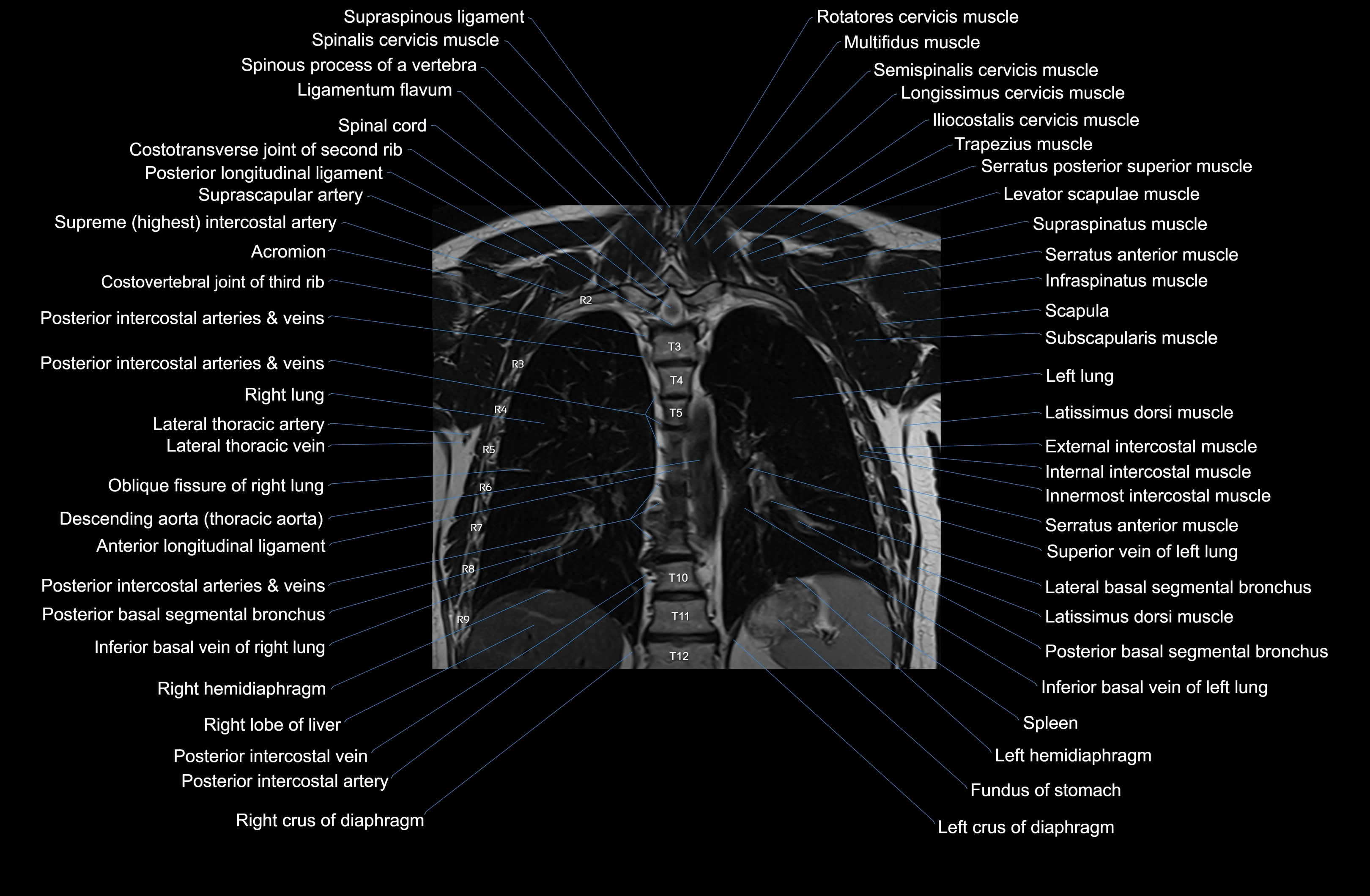 MRI Chest Anatomy – Axial, Coronal & Sagittal Planes with Labeled Images