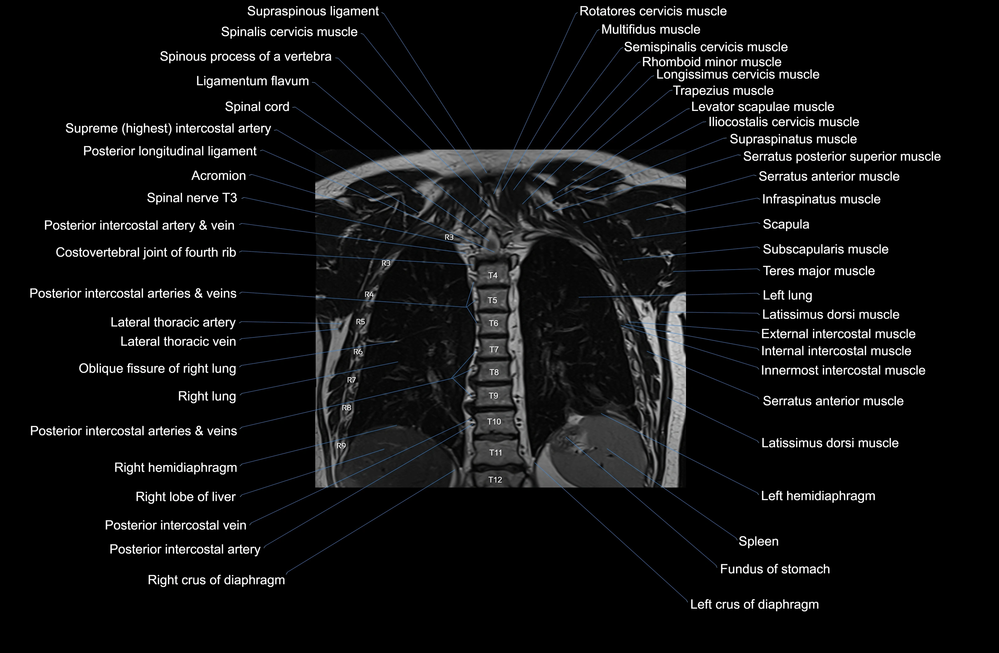 MRI Chest Anatomy – Axial, Coronal & Sagittal Planes with Labeled Images