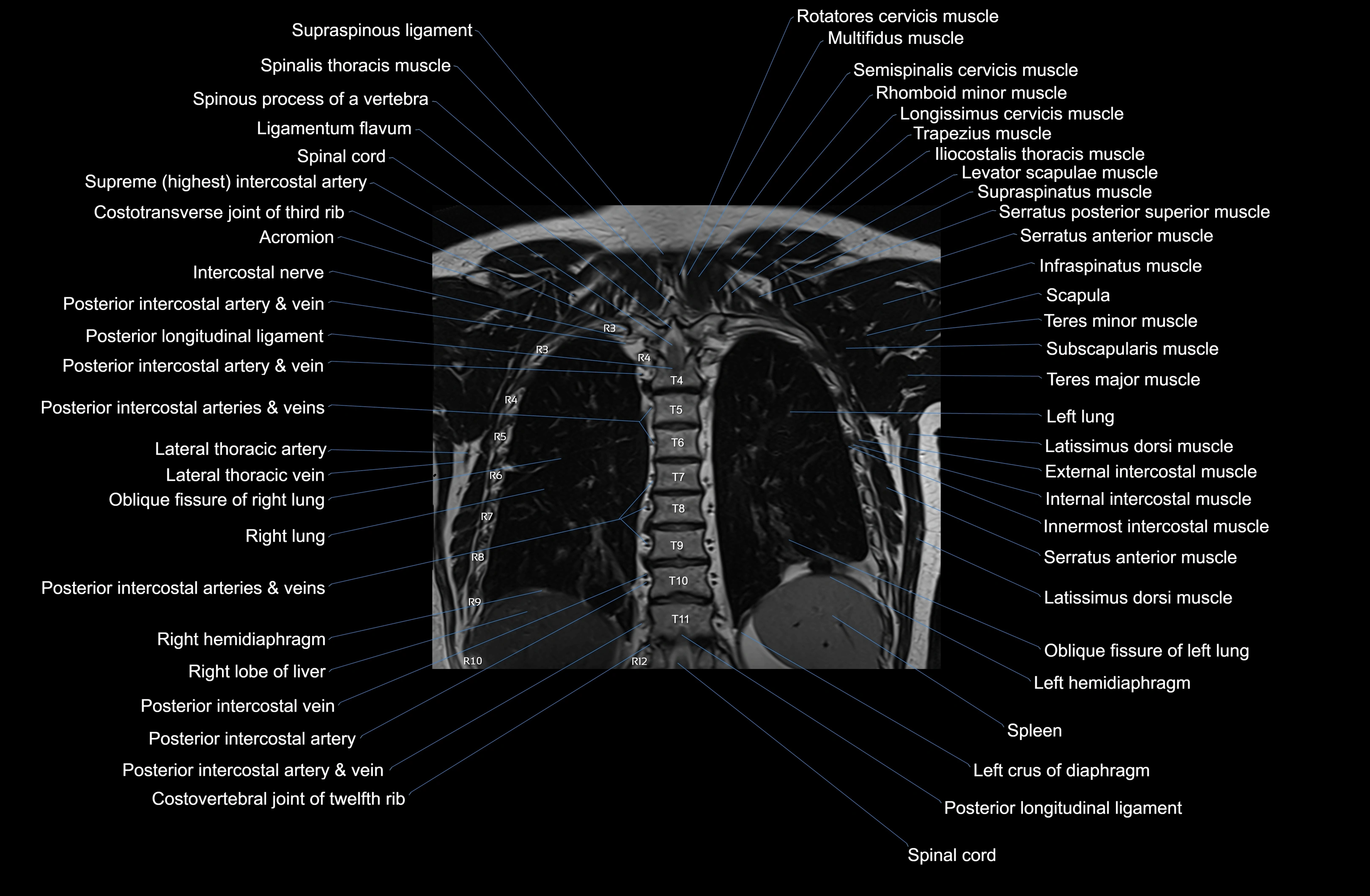 MRI Chest Anatomy – Axial, Coronal & Sagittal Planes with Labeled Images