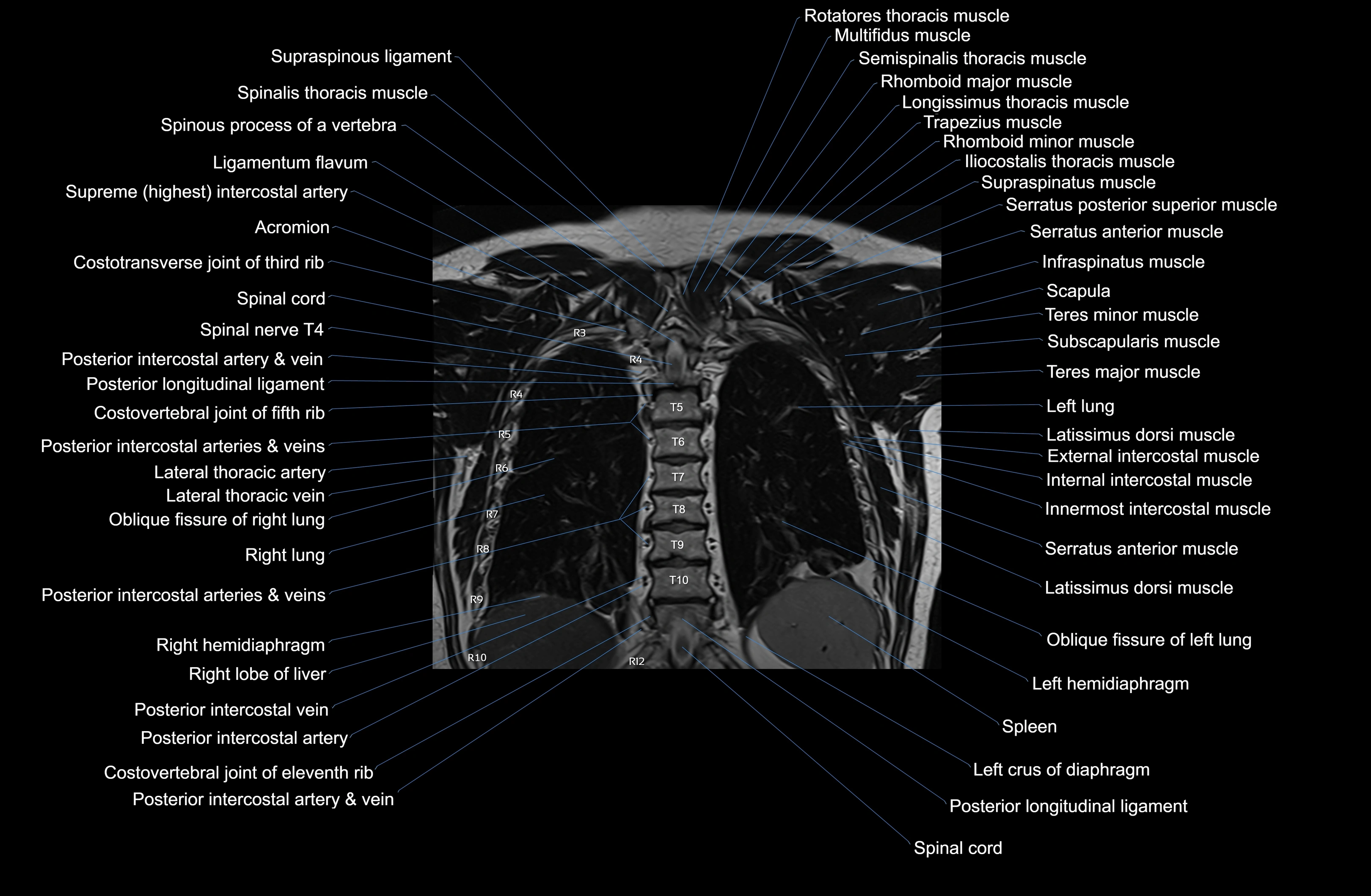 MRI Chest Anatomy – Axial, Coronal & Sagittal Planes with Labeled Images