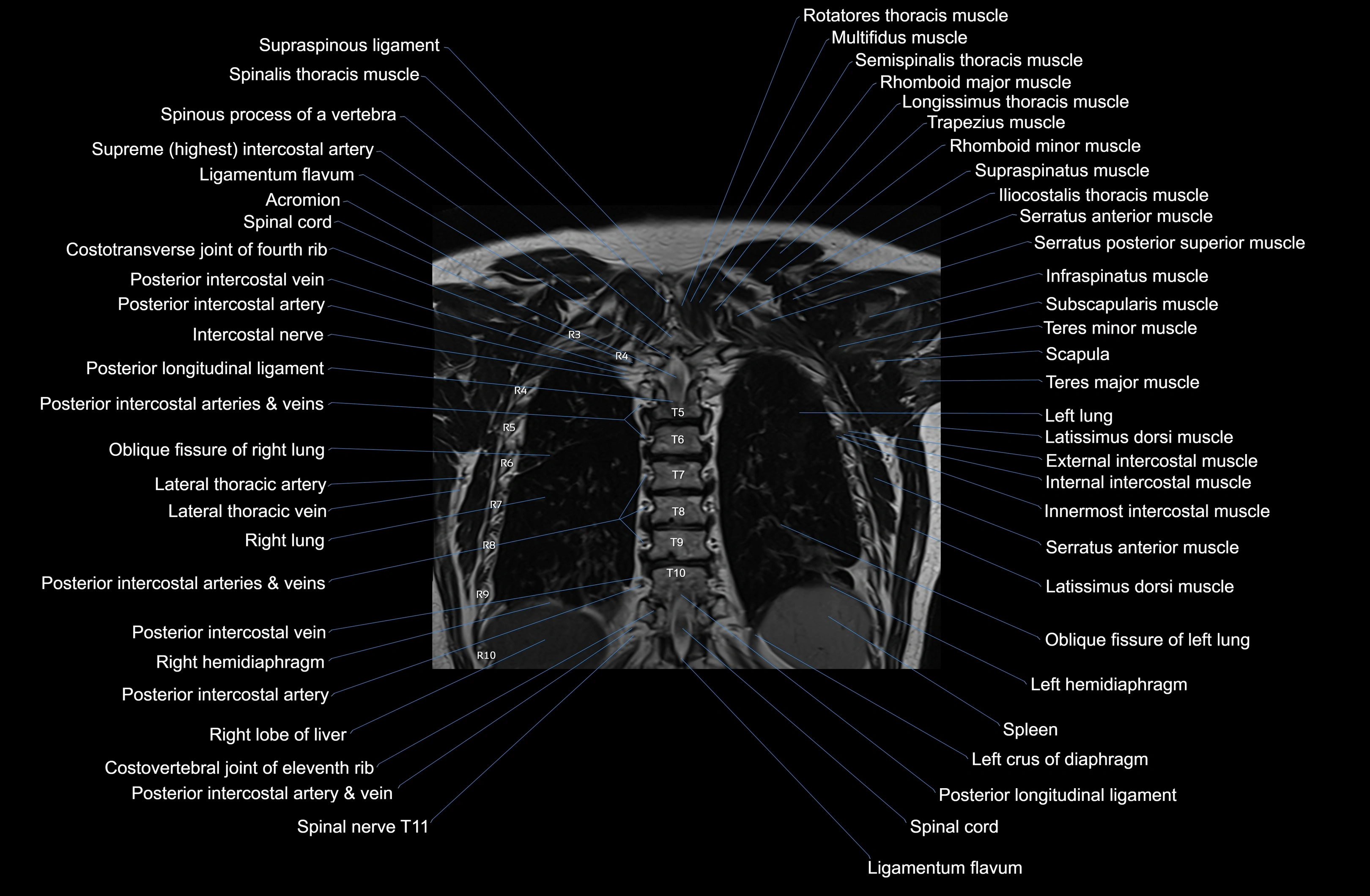 MRI Chest Anatomy – Axial, Coronal & Sagittal Planes with Labeled Images