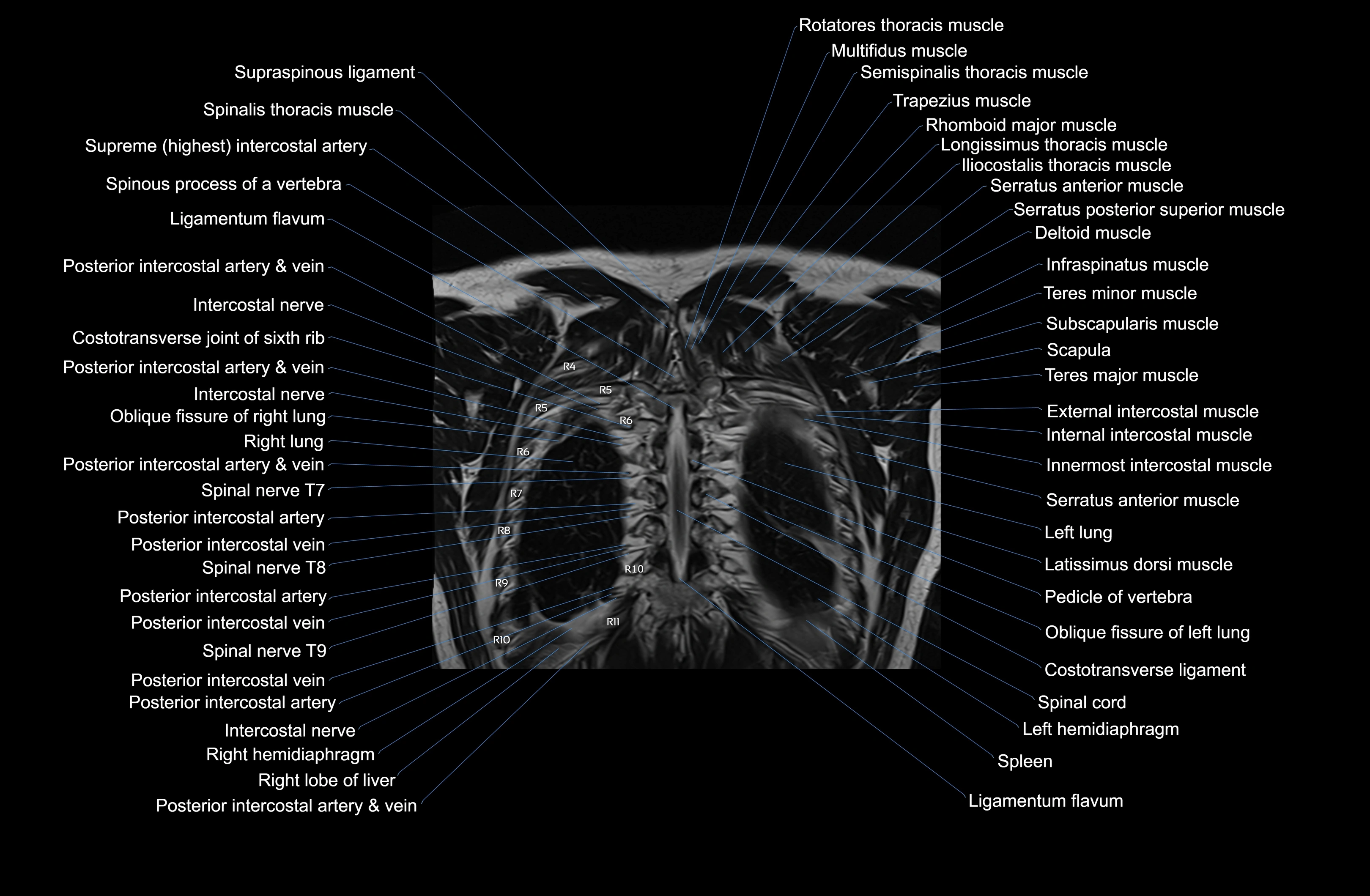MRI Chest Anatomy – Axial, Coronal & Sagittal Planes with Labeled Images