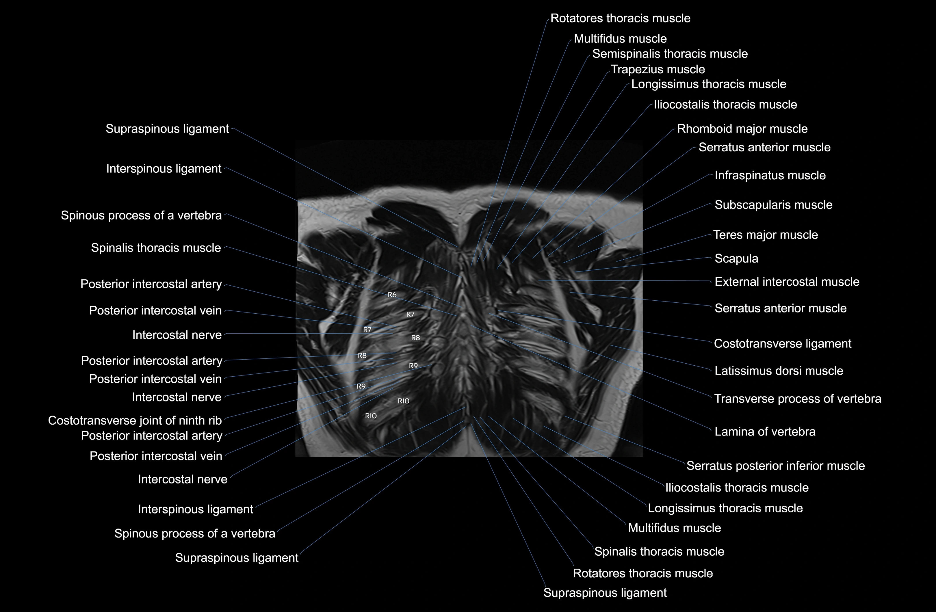 MRI Chest Anatomy – Axial, Coronal & Sagittal Planes with Labeled Images