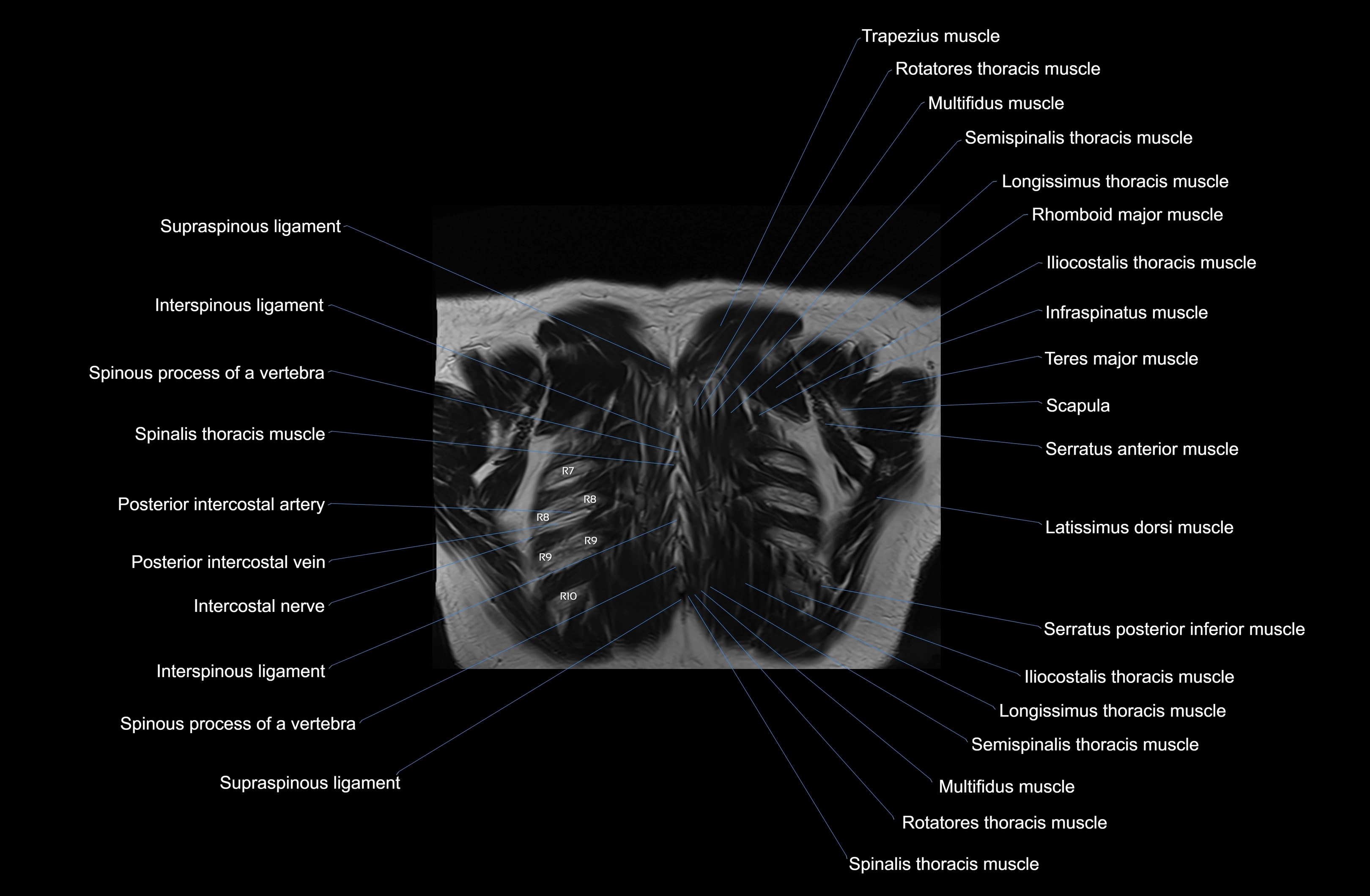 MRI Chest Anatomy – Axial, Coronal & Sagittal Planes with Labeled Images