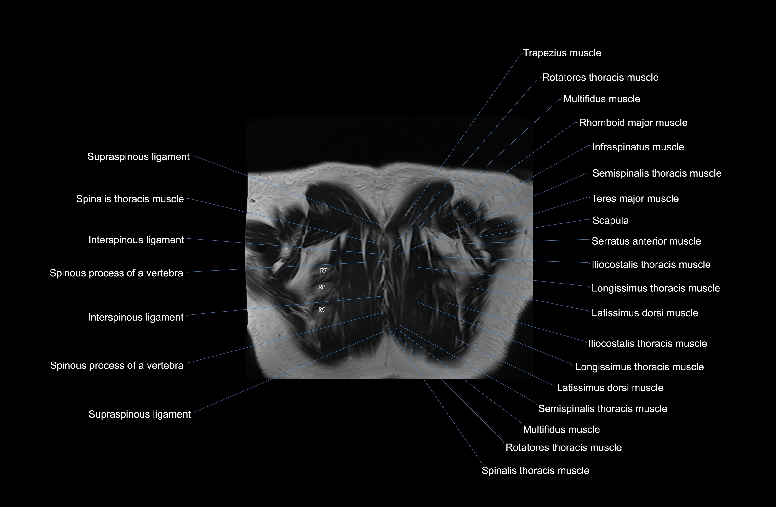 MRI Chest Anatomy – Axial, Coronal & Sagittal Planes with Labeled Images