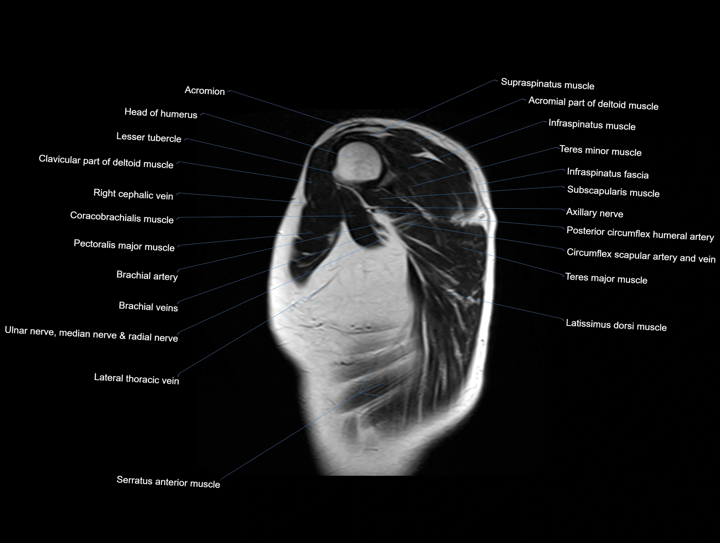 MRI Chest Anatomy – Axial, Coronal & Sagittal Planes with Labeled Images