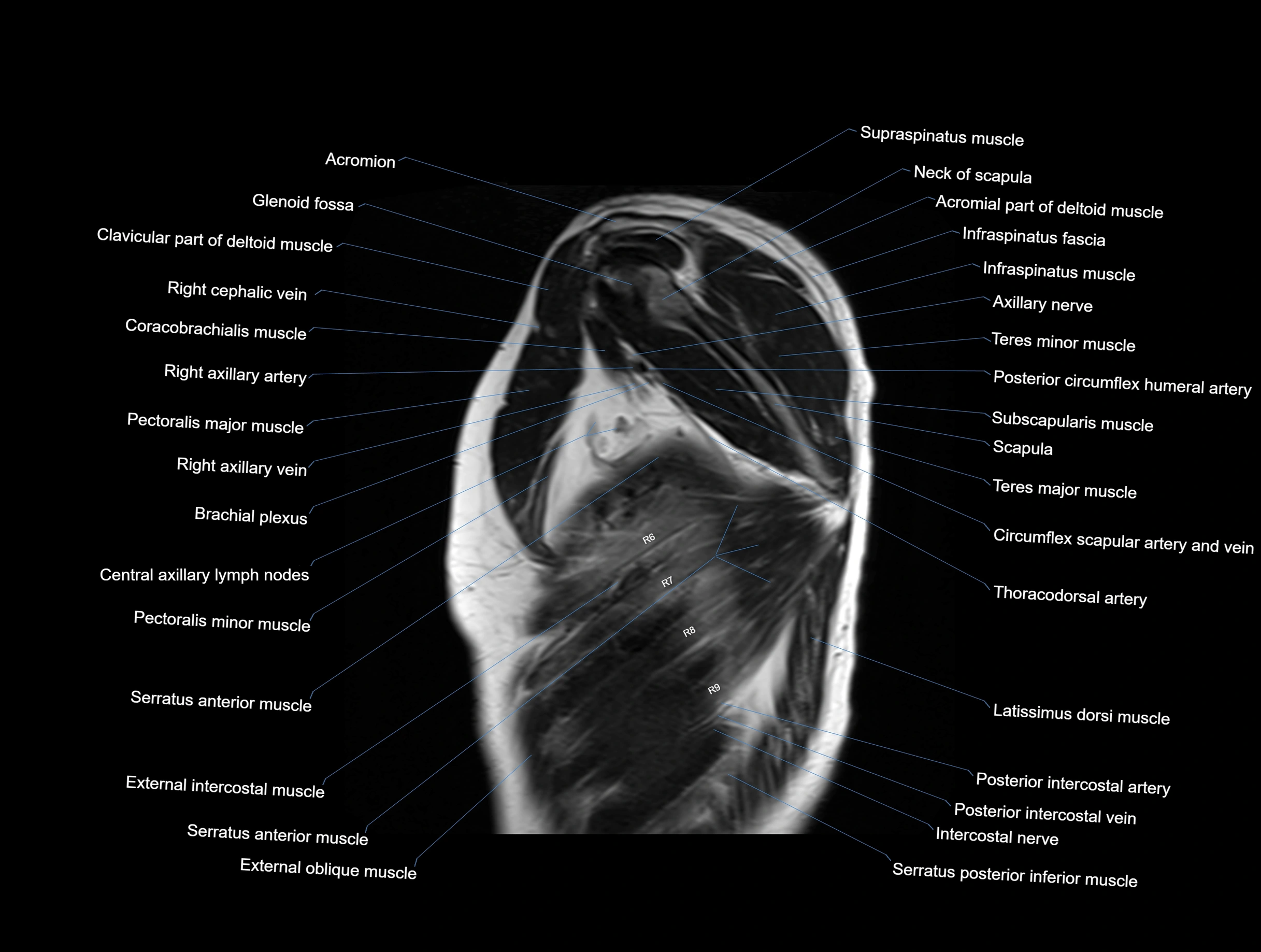 MRI Chest Anatomy – Axial, Coronal & Sagittal Planes with Labeled Images
