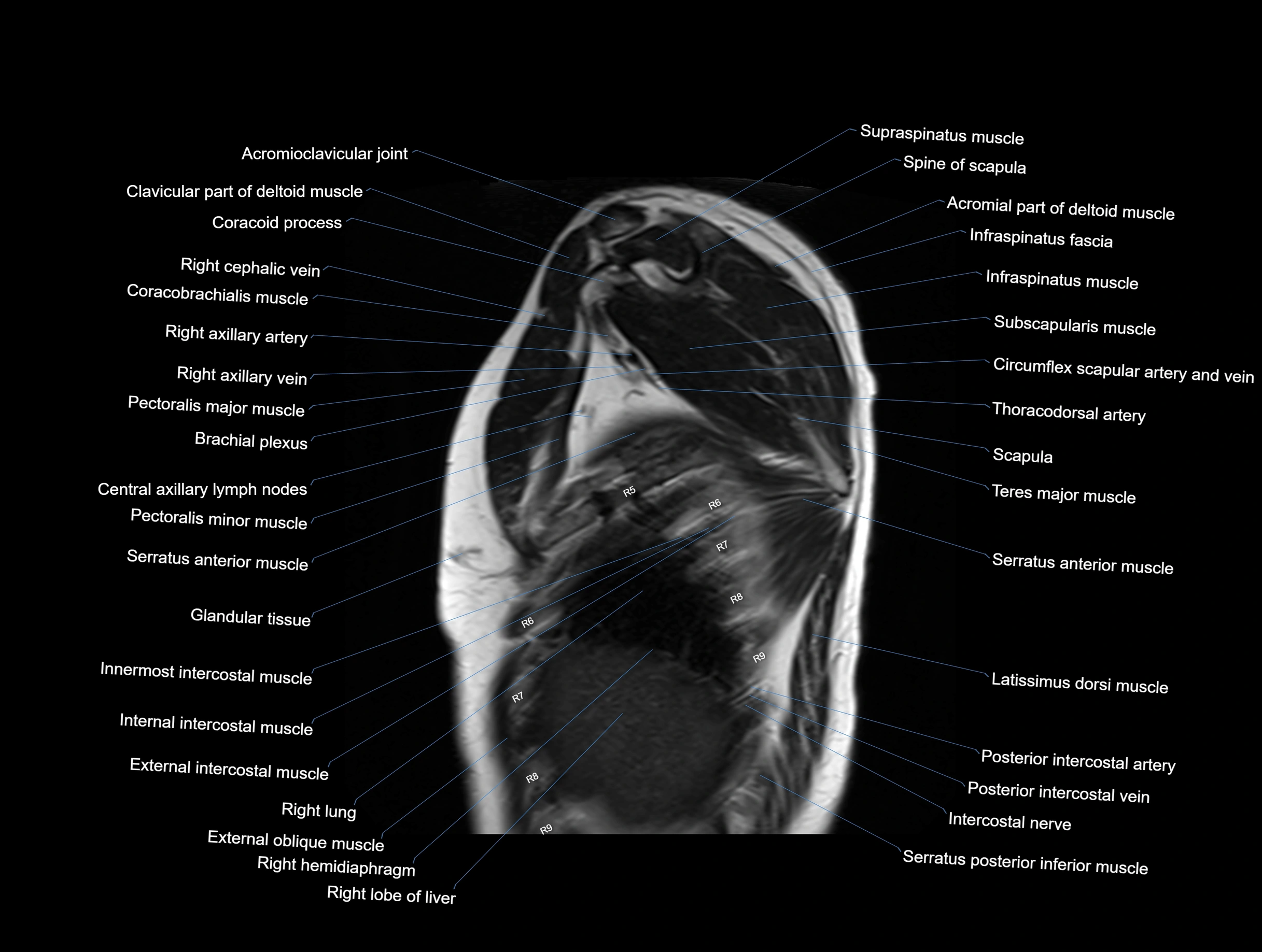 MRI Chest Anatomy – Axial, Coronal & Sagittal Planes with Labeled Images