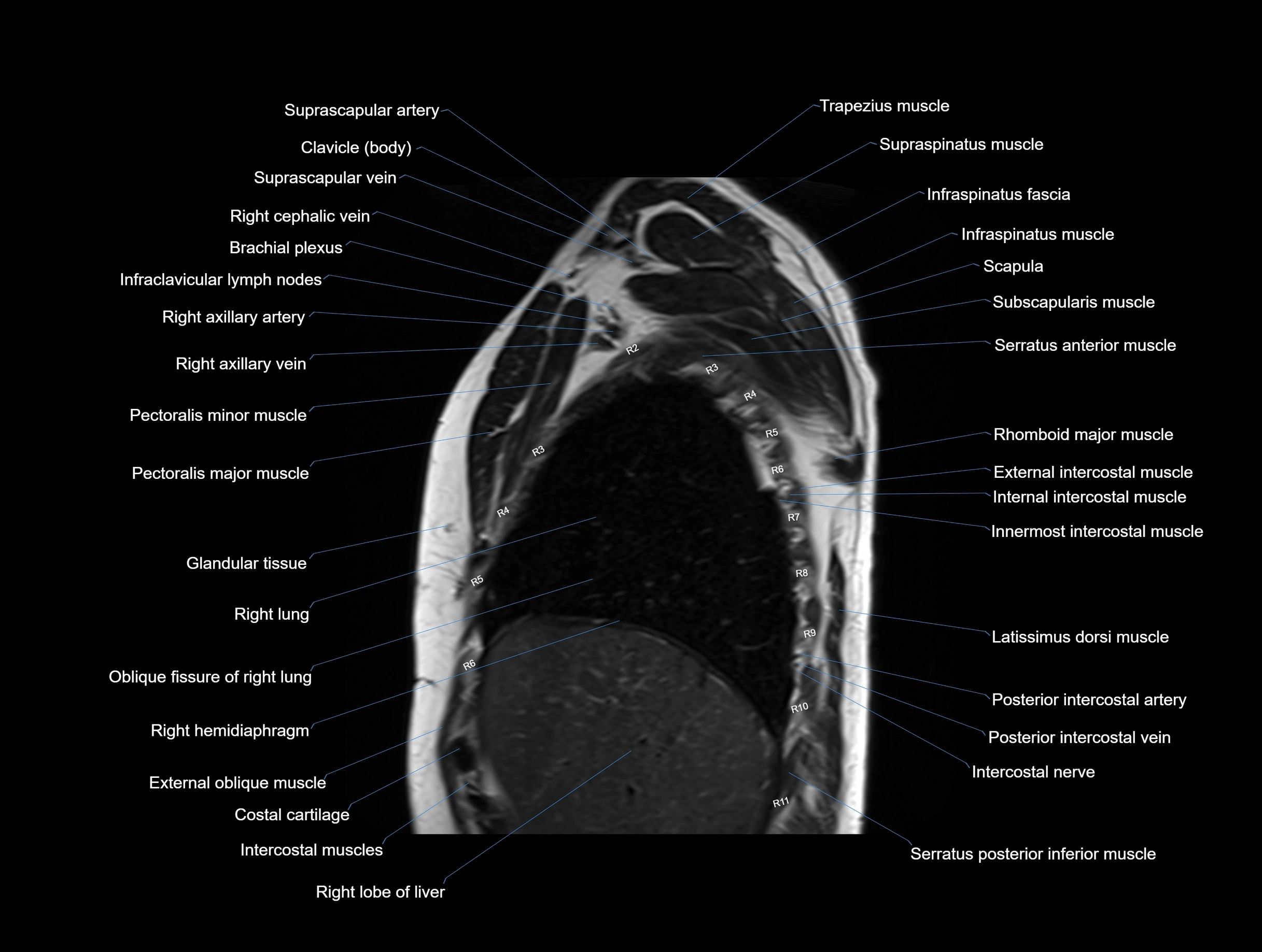 MRI Chest Anatomy – Axial, Coronal & Sagittal Planes with Labeled Images