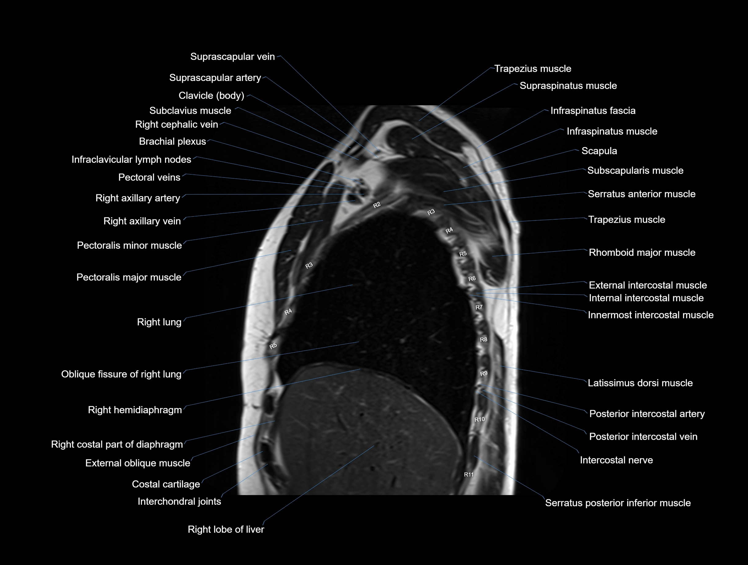 MRI Chest Anatomy – Axial, Coronal & Sagittal Planes with Labeled Images
