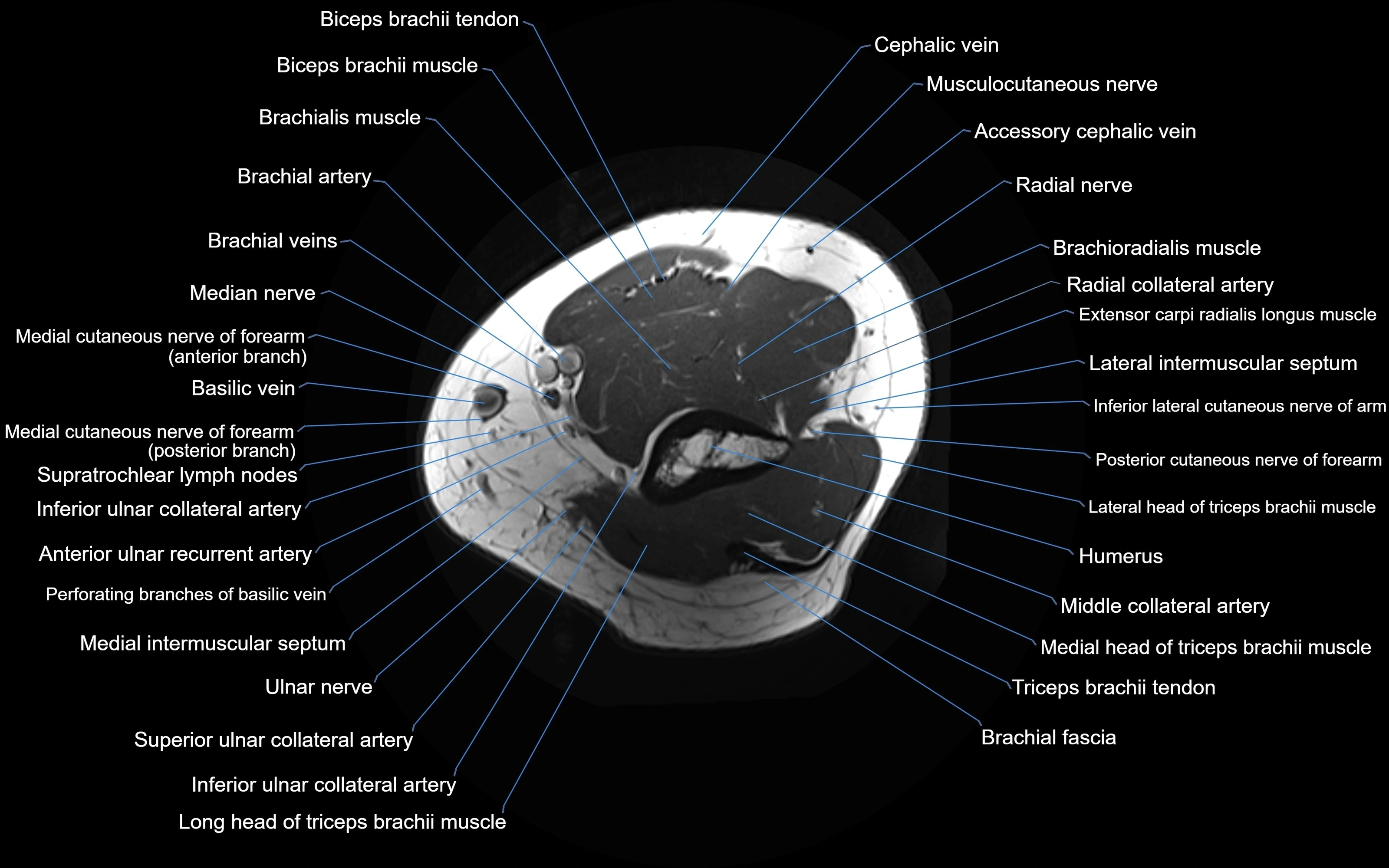 MRI Elbow Anatomy – Axial, Coronal & Sagittal Labeled Images