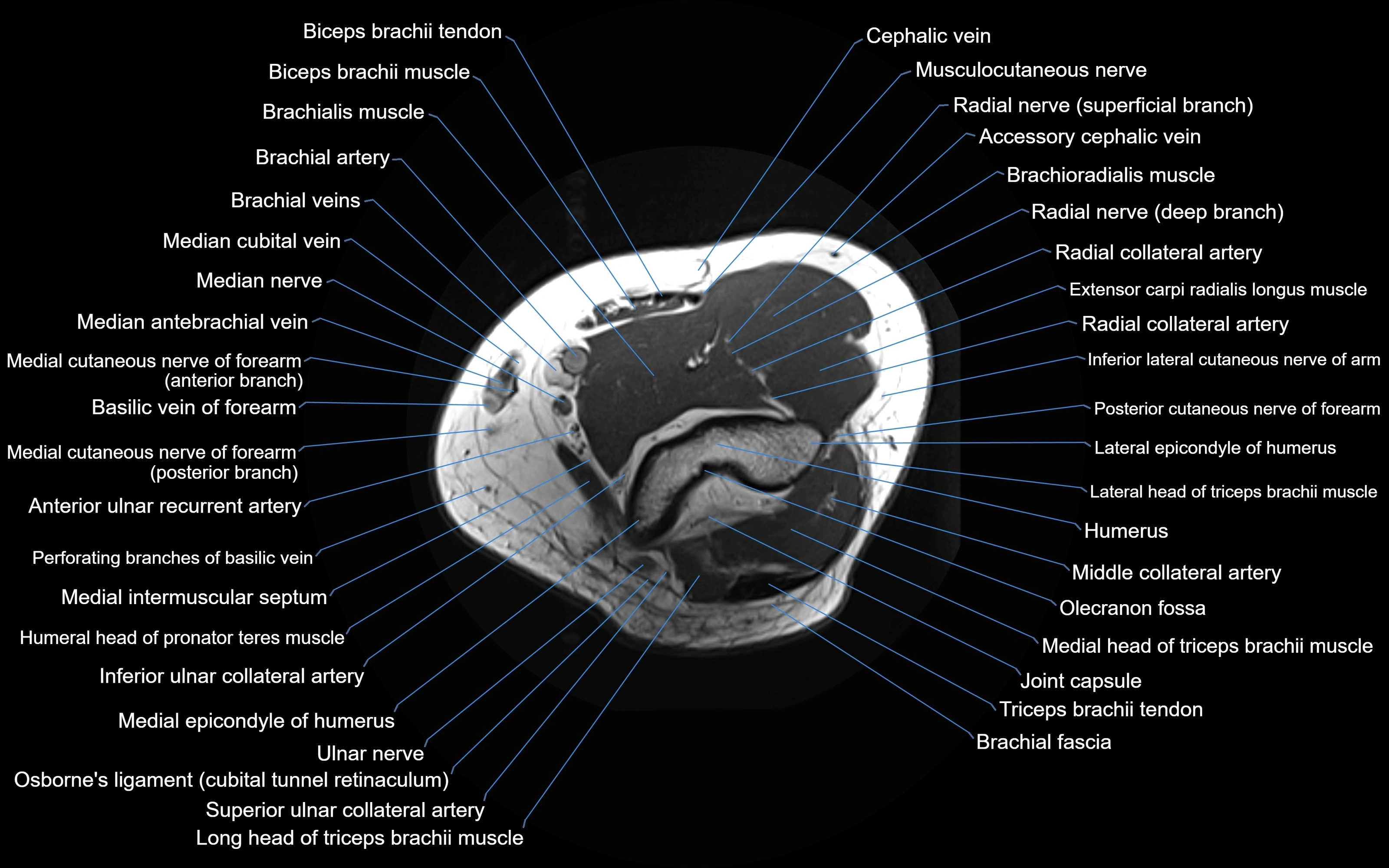 MRI Elbow Anatomy – Axial, Coronal & Sagittal Labeled Images