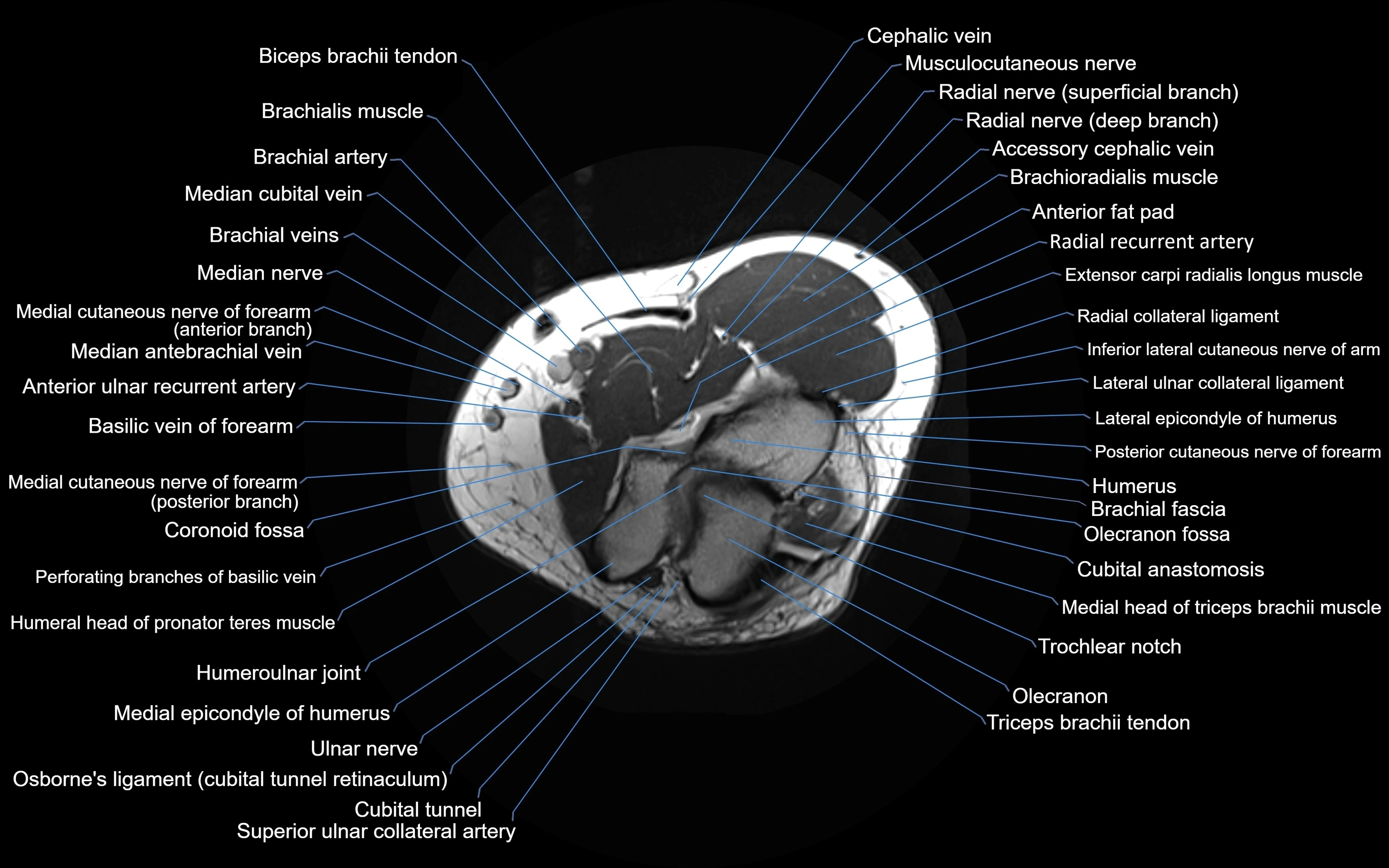 MRI Elbow Anatomy – Axial, Coronal & Sagittal Labeled Images