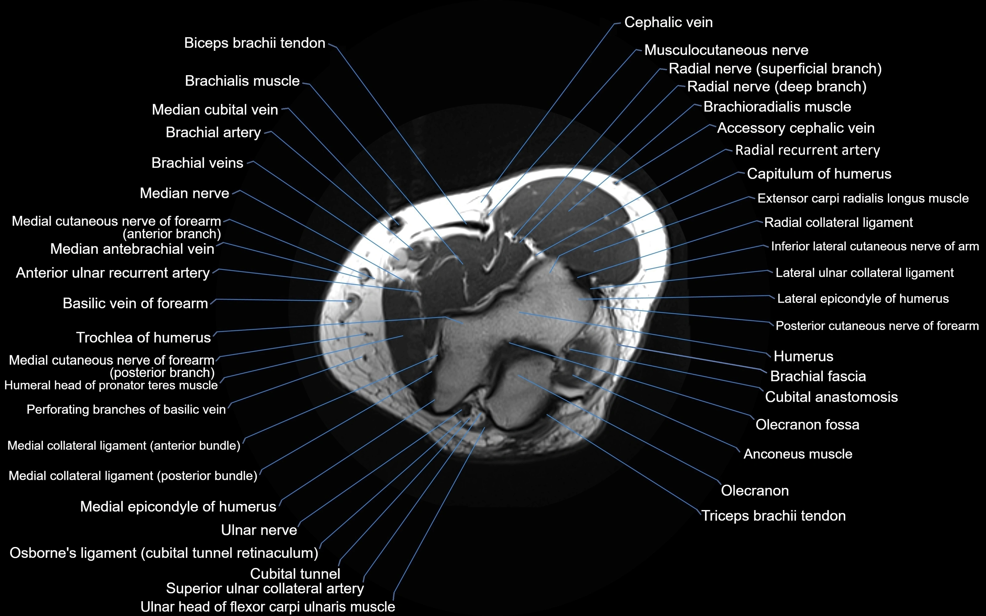 MRI Elbow Anatomy – Axial, Coronal & Sagittal Labeled Images