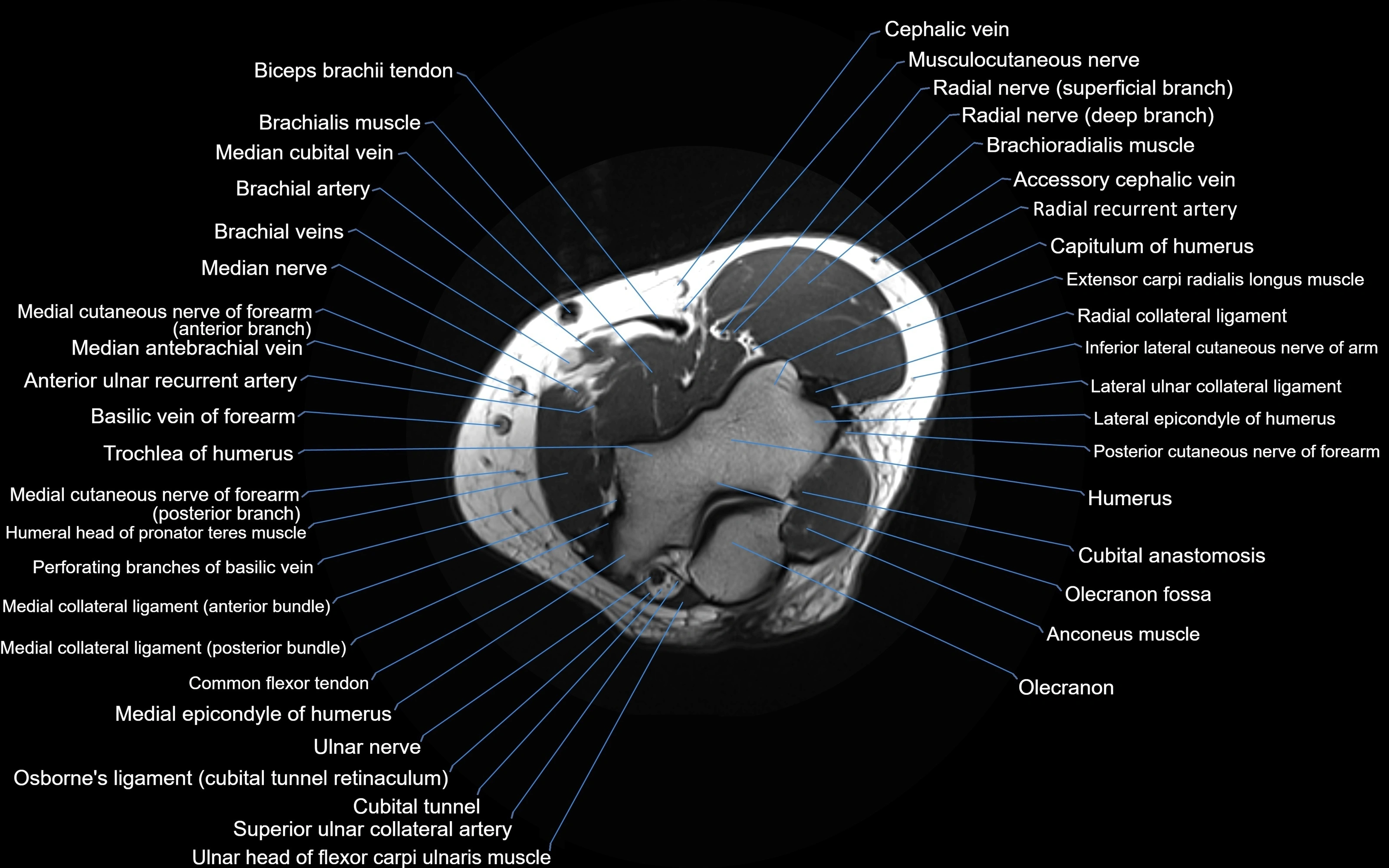 MRI Elbow Anatomy – Axial, Coronal & Sagittal Labeled Images