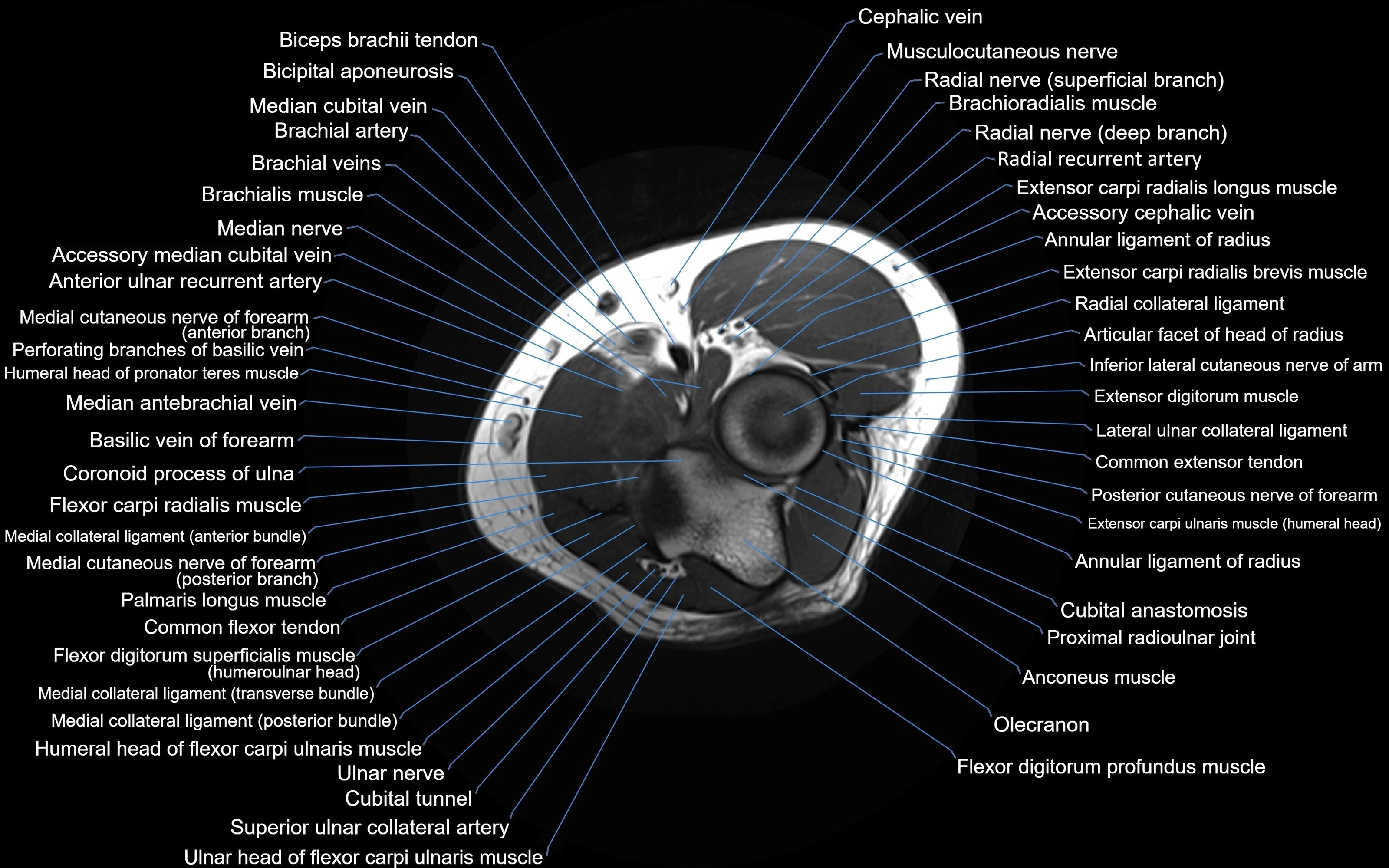 MRI Elbow Anatomy – Axial, Coronal & Sagittal Labeled Images