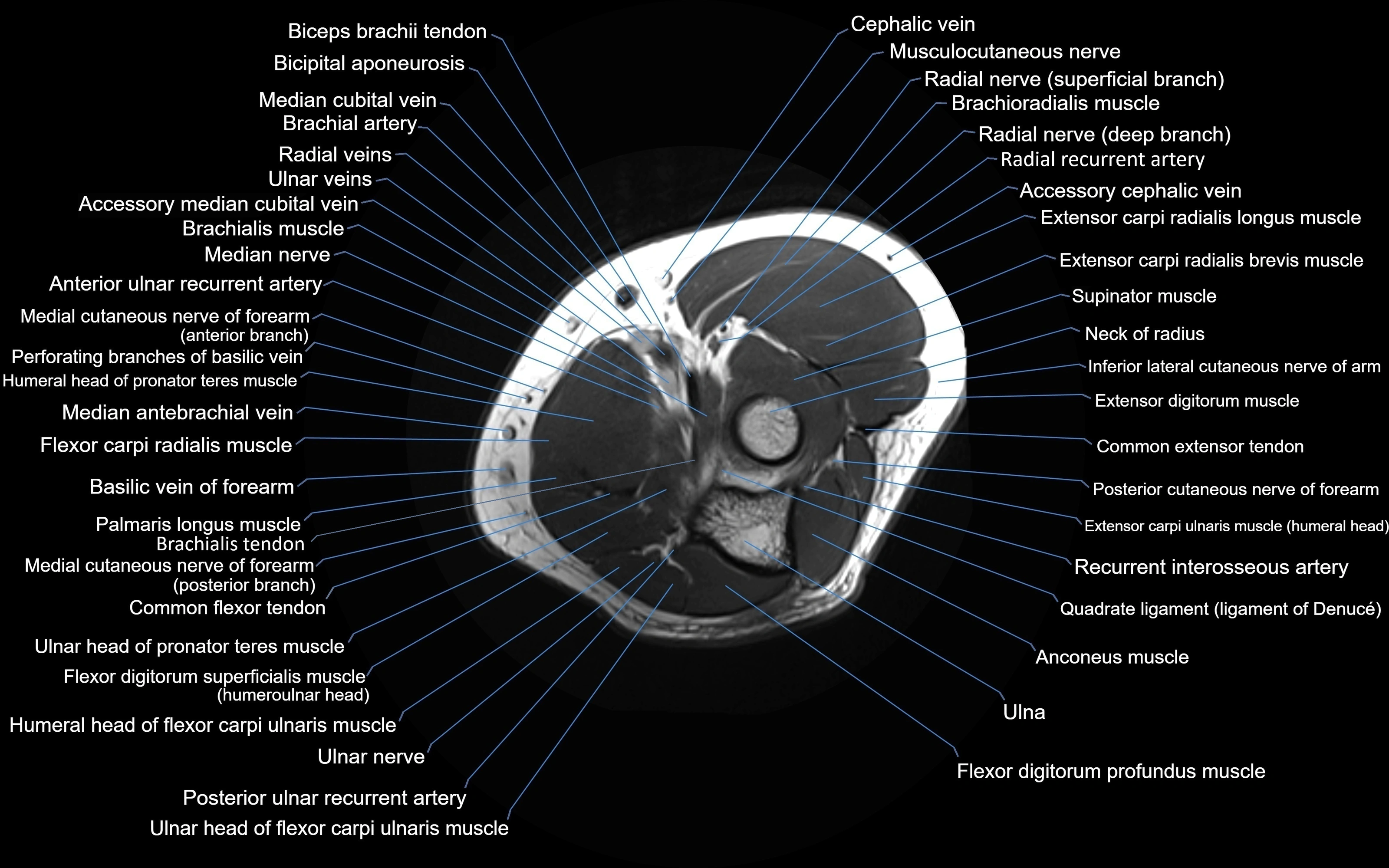 MRI Elbow Anatomy – Axial, Coronal & Sagittal Labeled Images
