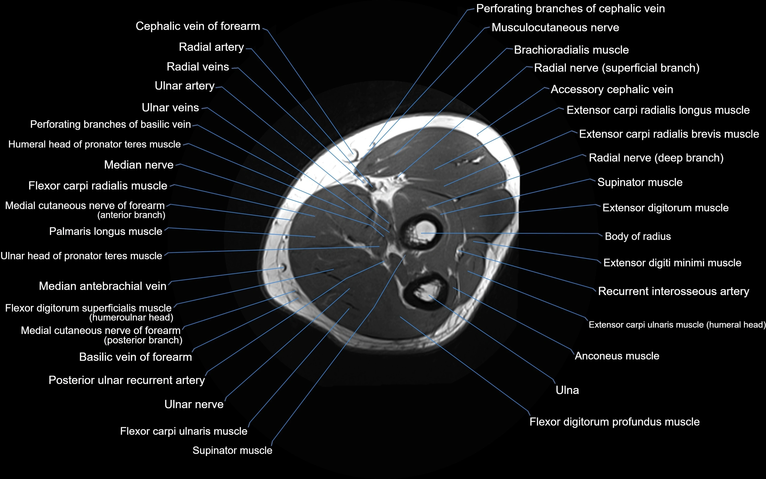 MRI Elbow Anatomy – Axial, Coronal & Sagittal Labeled Images