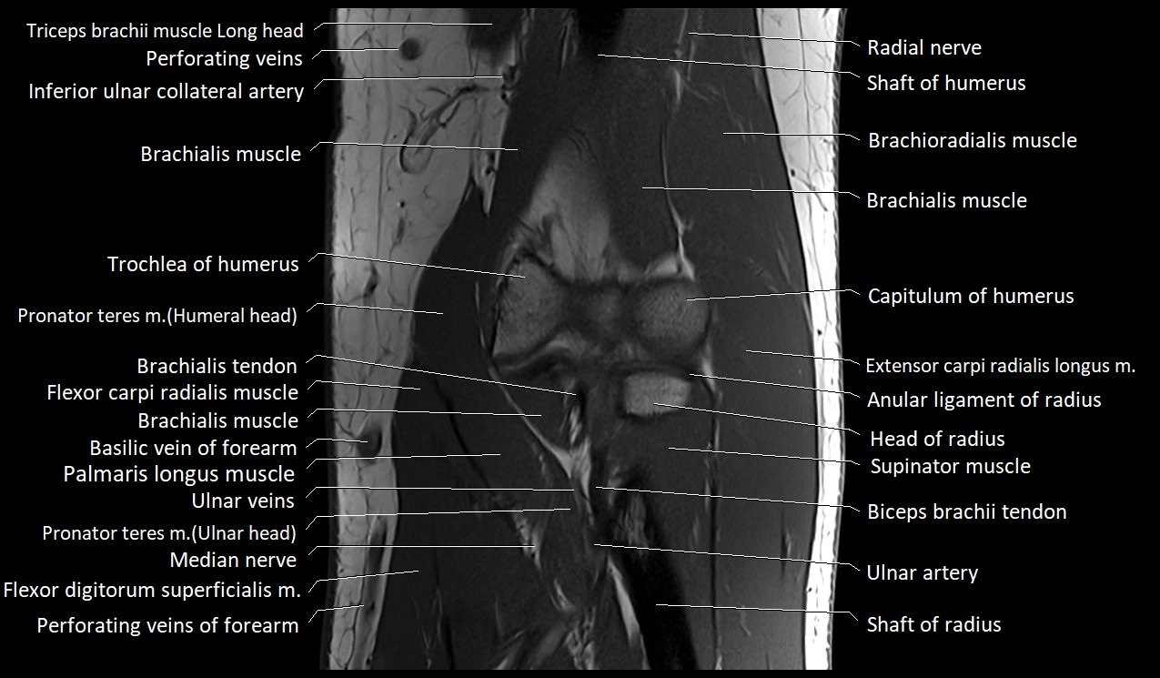 MRI Elbow Anatomy – Axial, Coronal & Sagittal Labeled Images