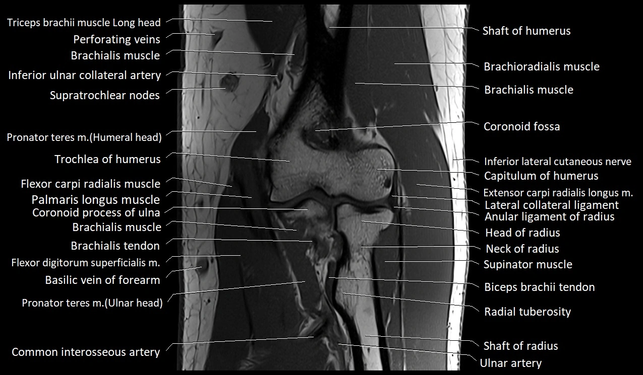MRI Elbow Anatomy – Axial, Coronal & Sagittal Labeled Images