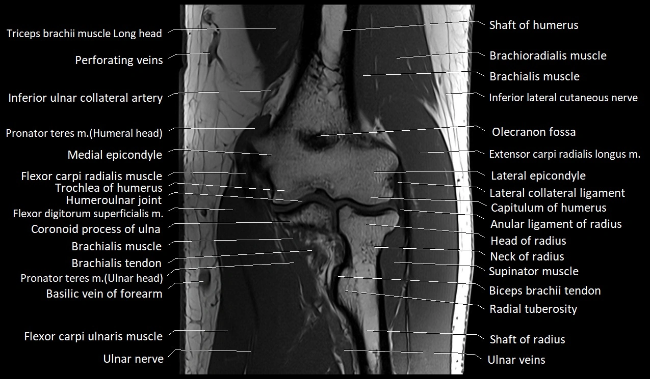 MRI Elbow Anatomy – Axial, Coronal & Sagittal Labeled Images