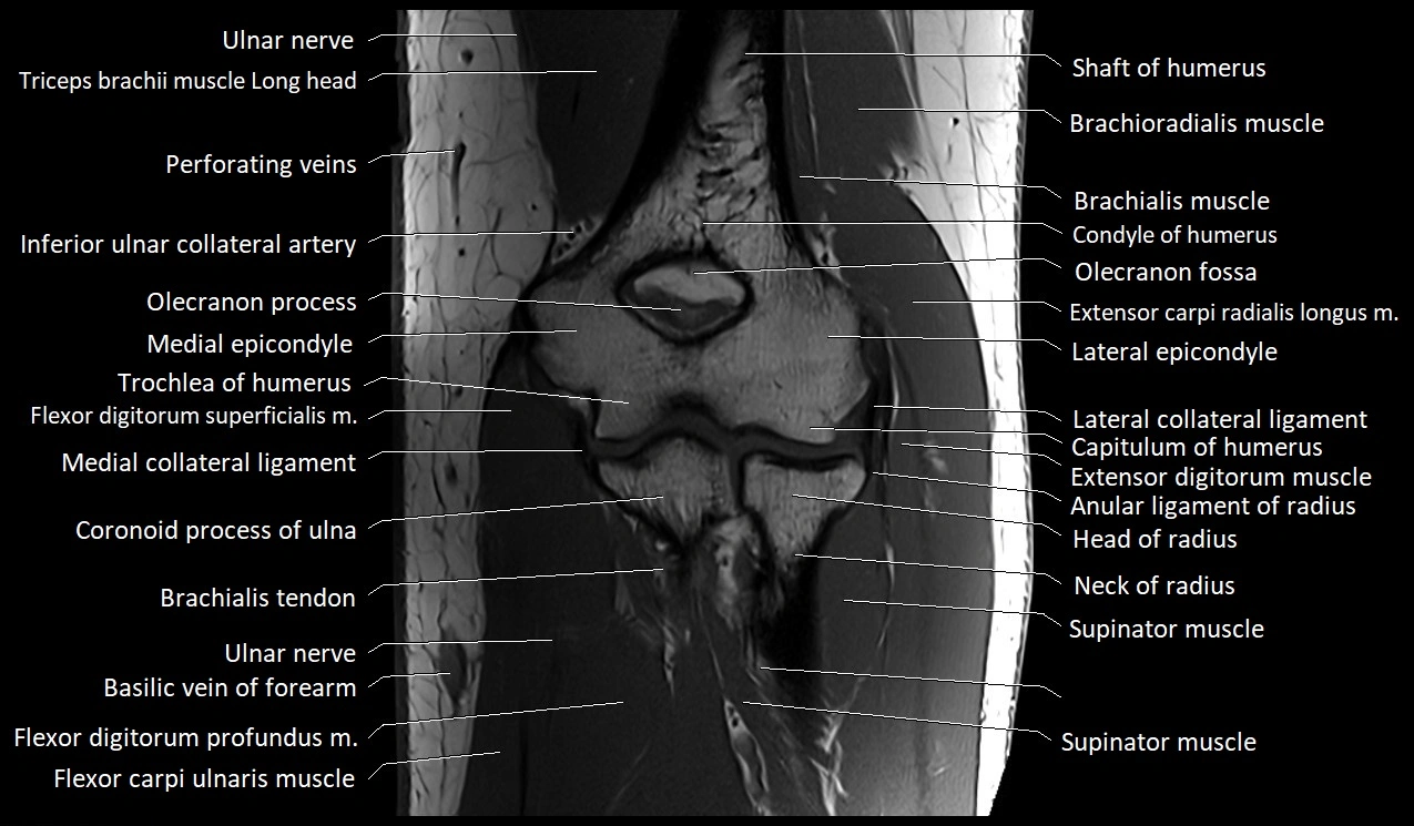 MRI Elbow Anatomy – Axial, Coronal & Sagittal Labeled Images