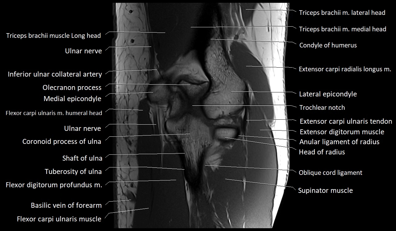 MRI Elbow Anatomy – Axial, Coronal & Sagittal Labeled Images