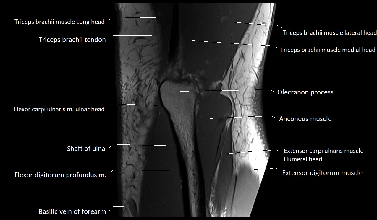MRI Elbow Anatomy – Axial, Coronal & Sagittal Labeled Images