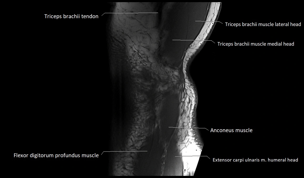 MRI Elbow Anatomy – Axial, Coronal & Sagittal Labeled Images