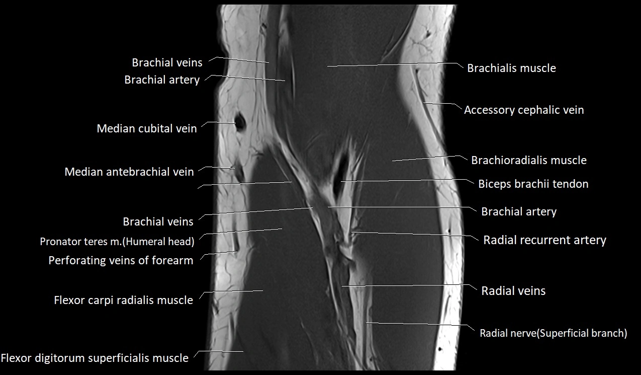 MRI Elbow Anatomy – Axial, Coronal & Sagittal Labeled Images