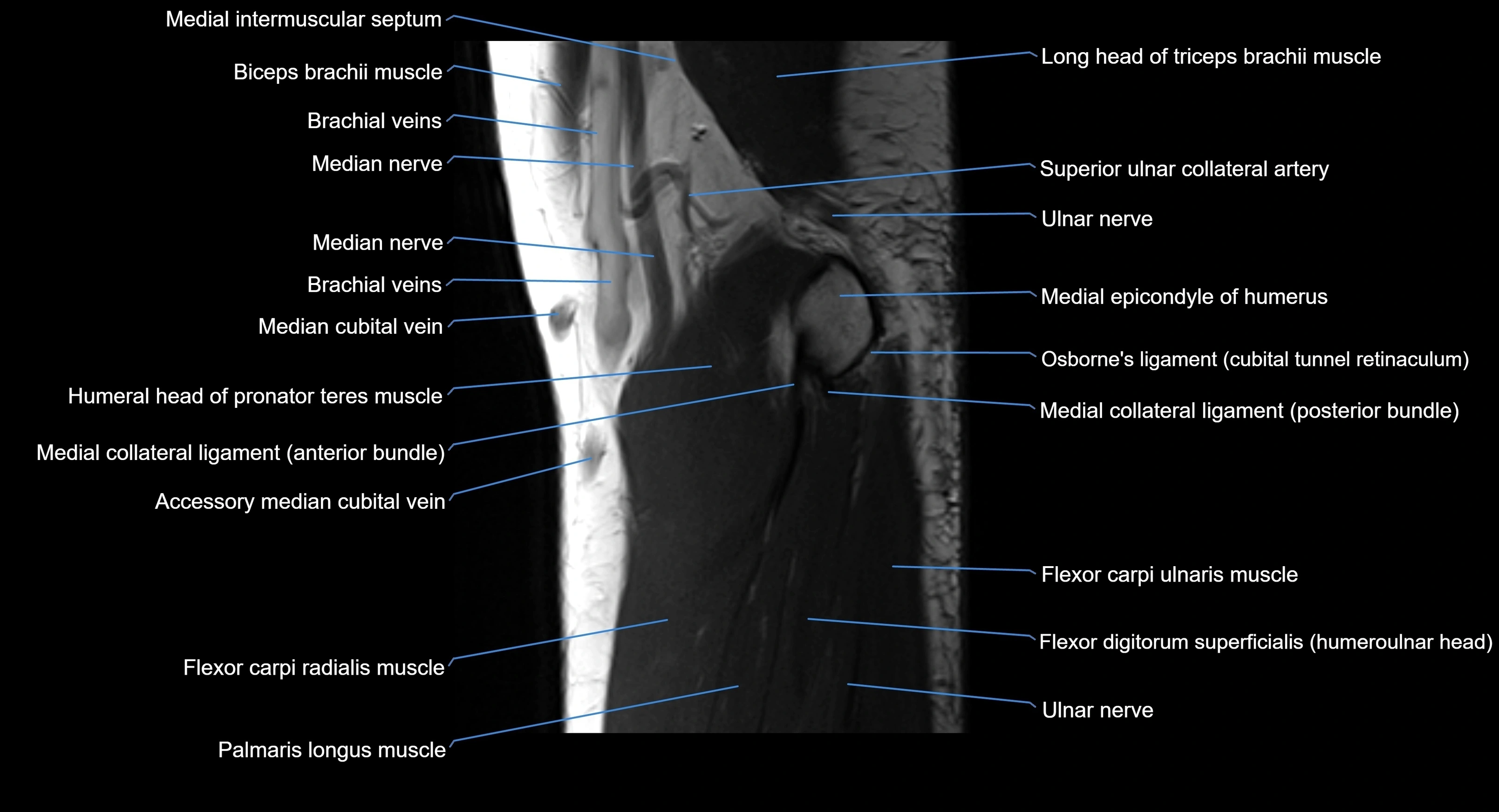 MRI Elbow Anatomy – Axial, Coronal & Sagittal Labeled Images