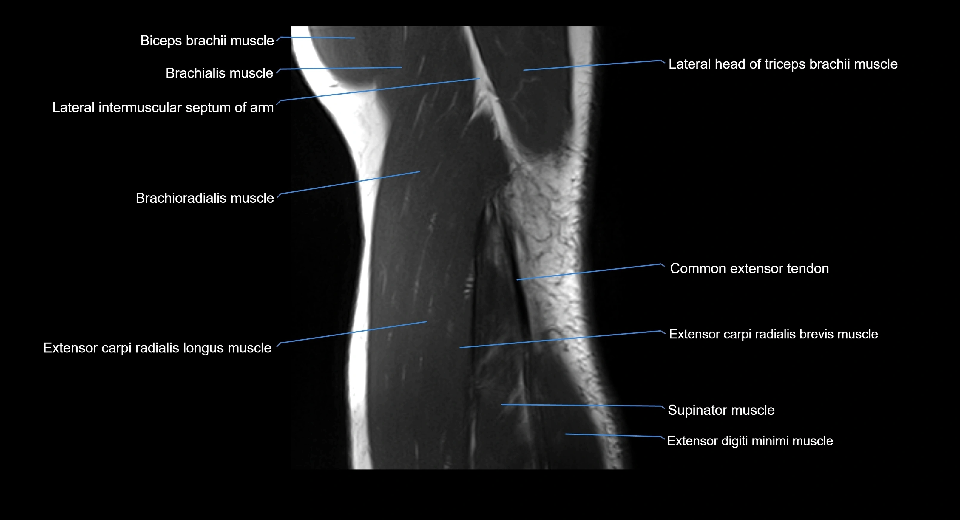 MRI Elbow Anatomy – Axial, Coronal & Sagittal Labeled Images