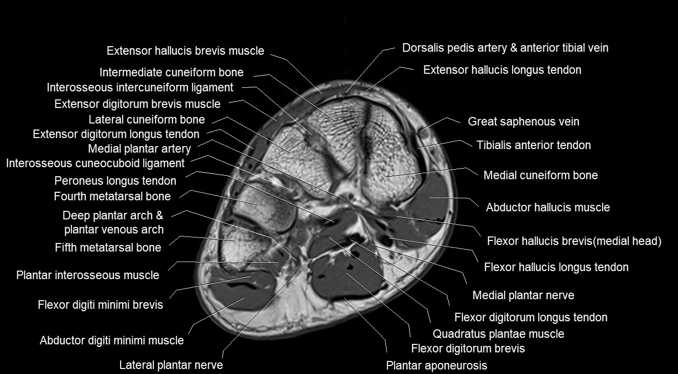 MRI Foot Anatomy – Axial, Coronal & Sagittal Cross-Sectional Labeled Images