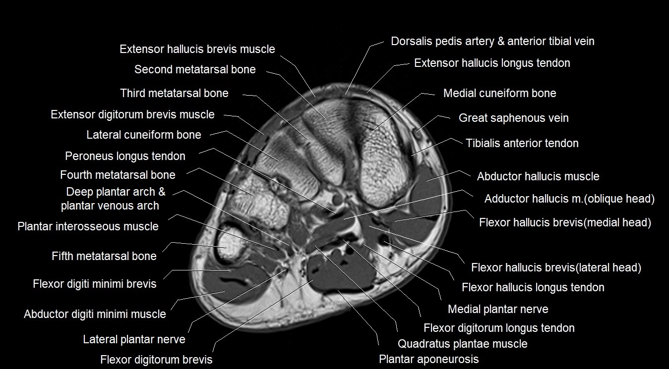 MRI Foot Anatomy – Axial, Coronal & Sagittal Cross-Sectional Labeled Images