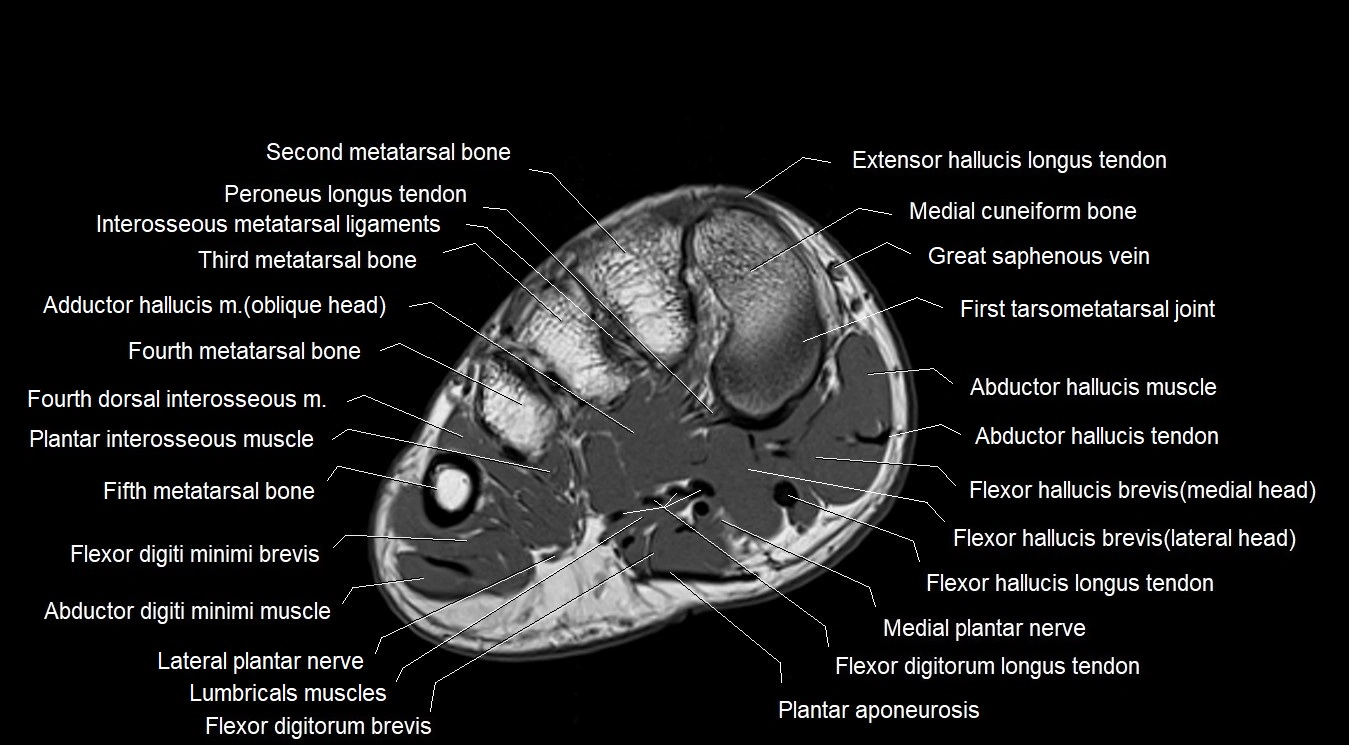 MRI Foot Anatomy – Axial, Coronal & Sagittal Cross-Sectional Labeled Images