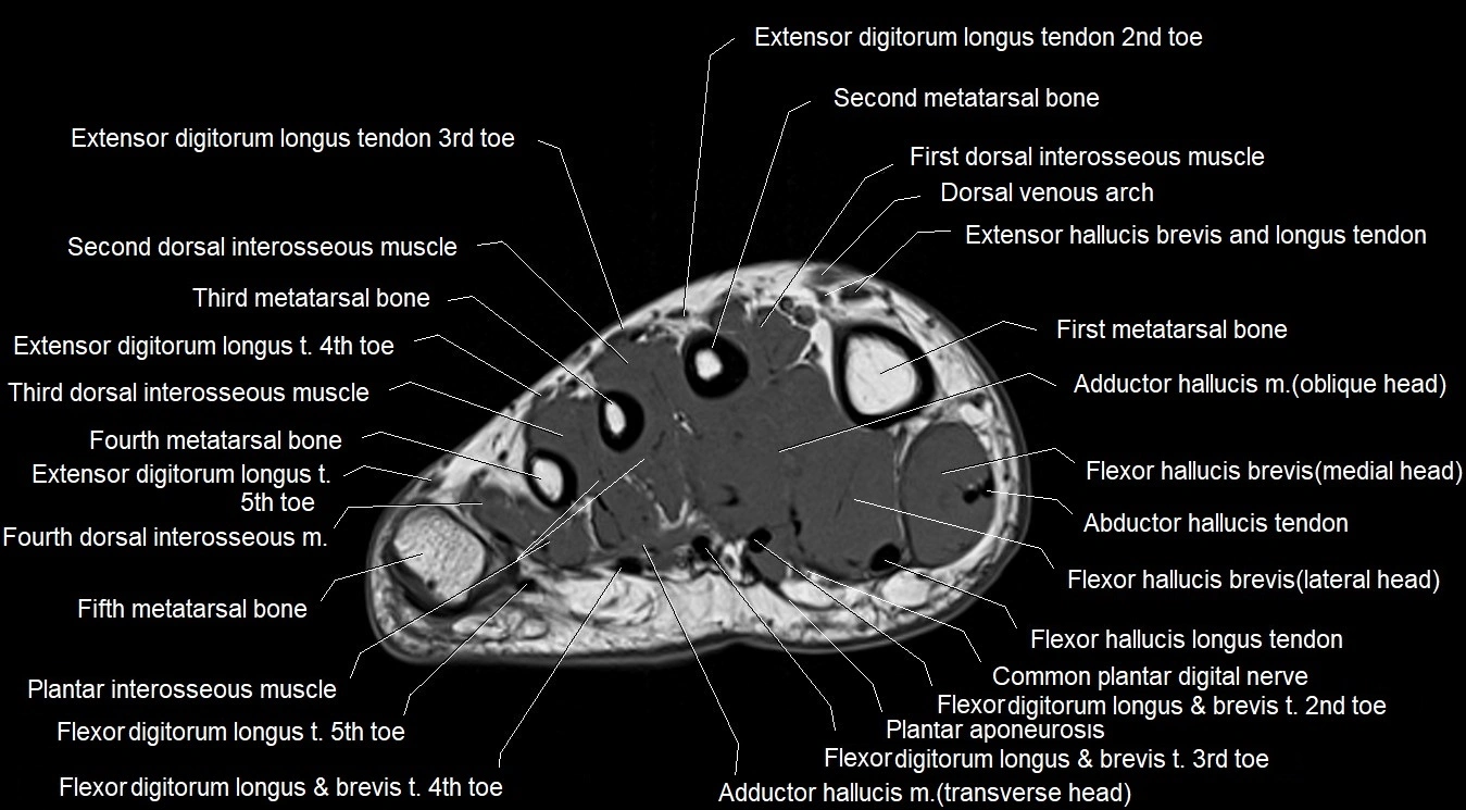 MRI Foot Anatomy – Axial, Coronal & Sagittal Cross-Sectional Labeled Images