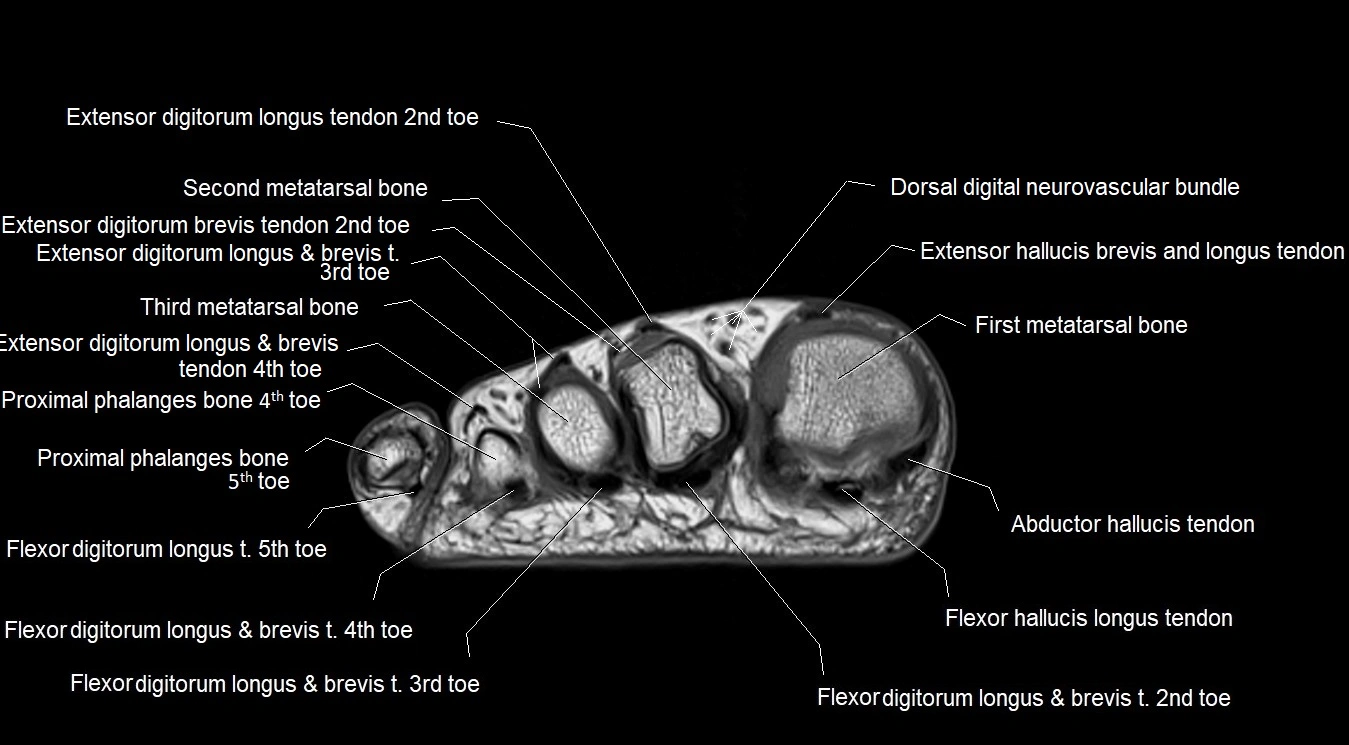 MRI Foot Anatomy – Axial, Coronal & Sagittal Cross-Sectional Labeled Images