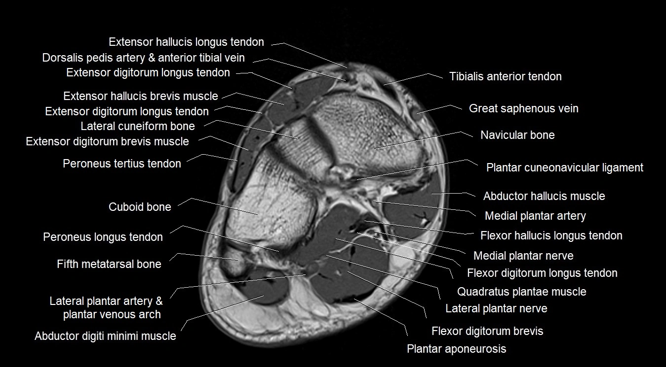MRI Foot Anatomy – Axial, Coronal & Sagittal Cross-Sectional Labeled Images