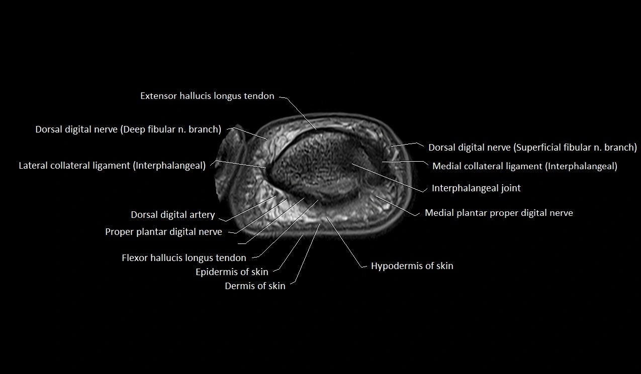 MRI Great Toe Anatomy – Labeled Axial, Coronal & Sagittal Cross-Sections