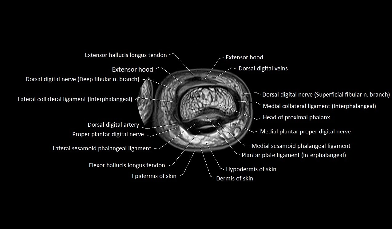 MRI Great Toe Anatomy – Labeled Axial, Coronal & Sagittal Cross-Sections