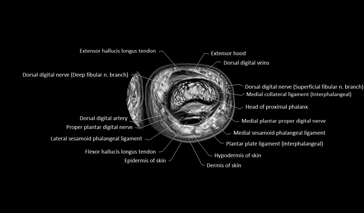 MRI Great Toe Anatomy – Labeled Axial, Coronal & Sagittal Cross-Sections
