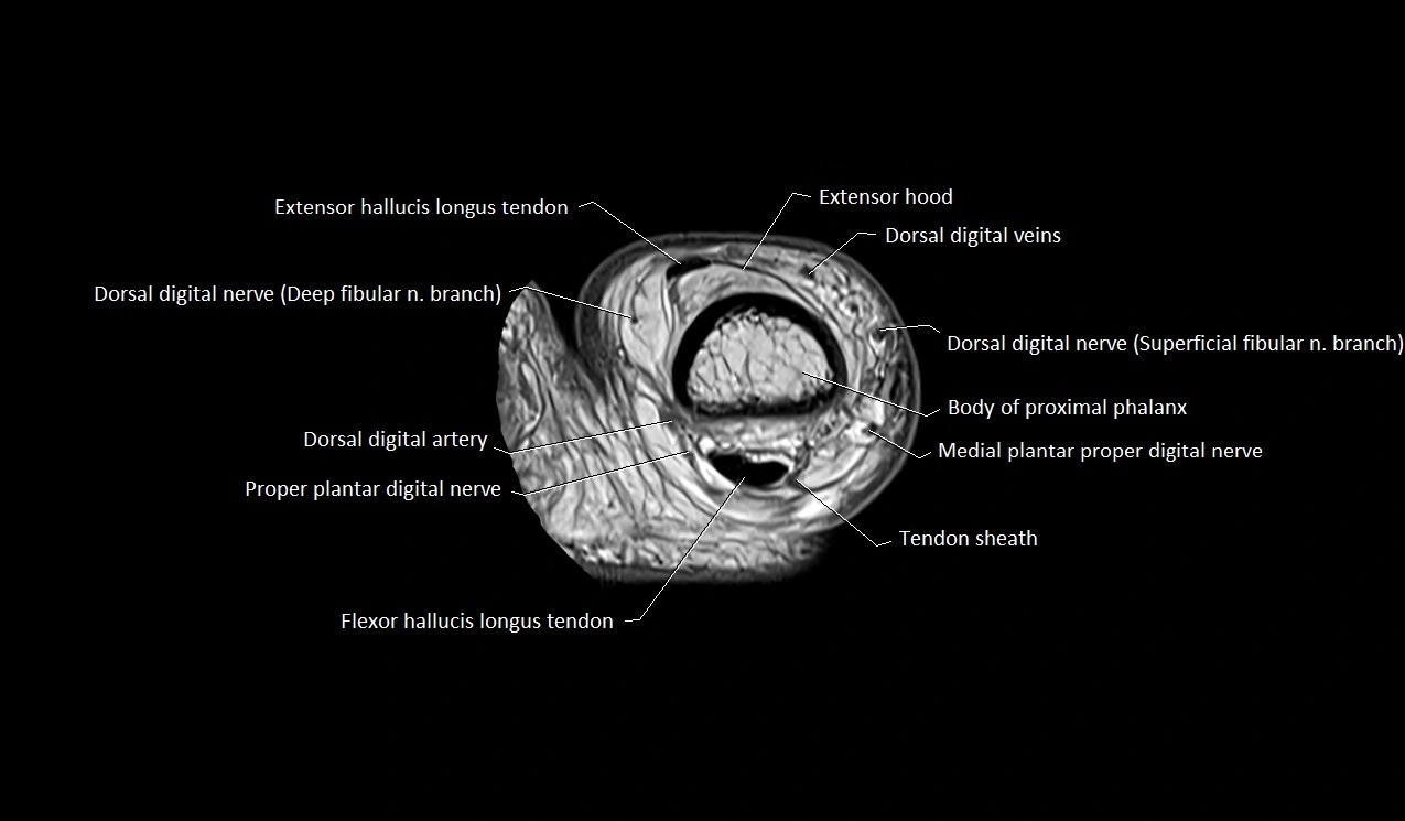 MRI Great Toe Anatomy – Labeled Axial, Coronal & Sagittal Cross-Sections